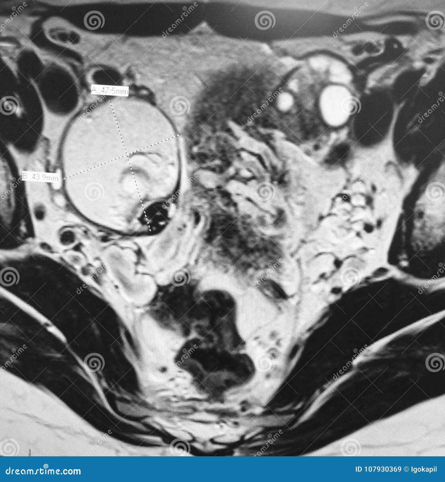 Teratoma Stock Photos by Megapixl