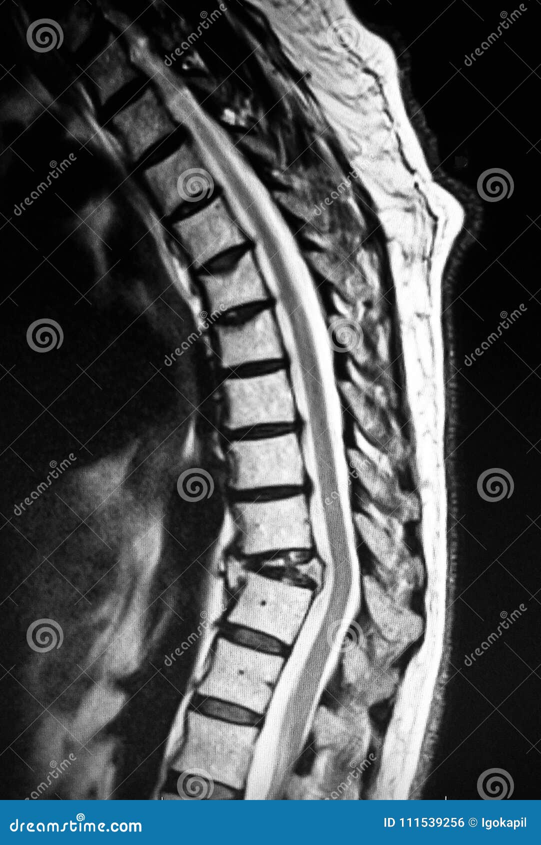 thoracic vertebrae pathological body compression mri