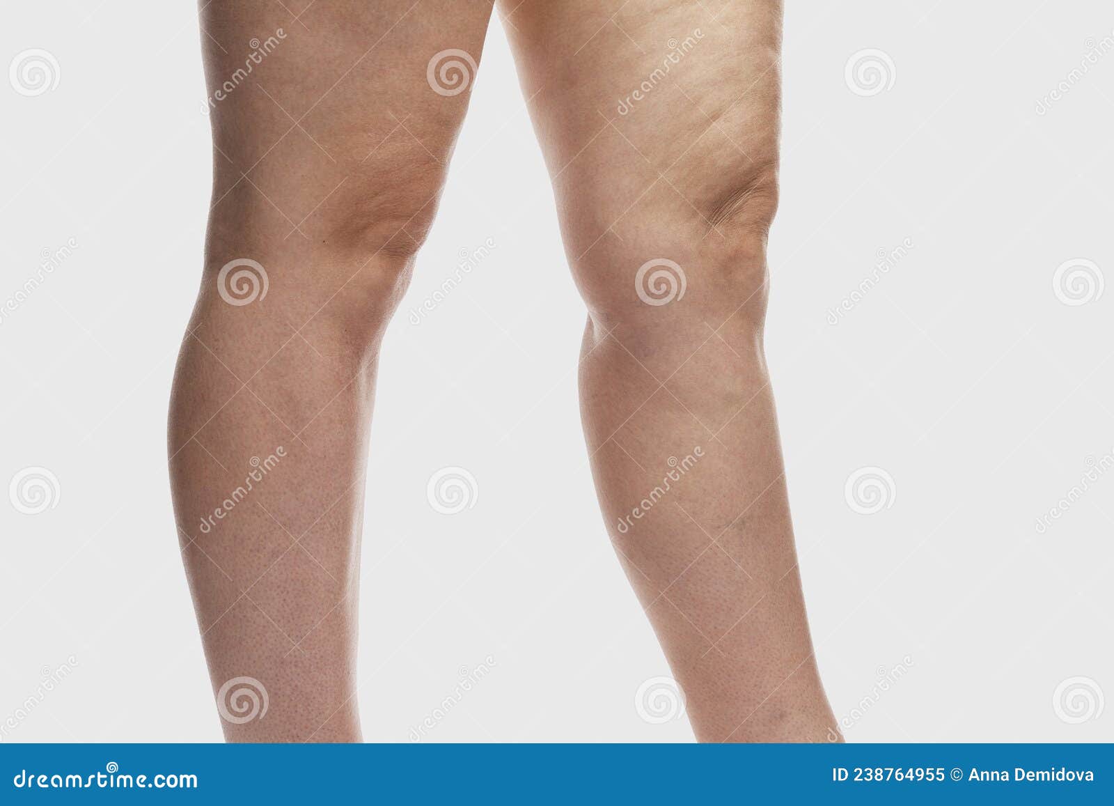 Thick Female Legs With Cellulite And Varicose Veins Overweight And Disease Close Up On A