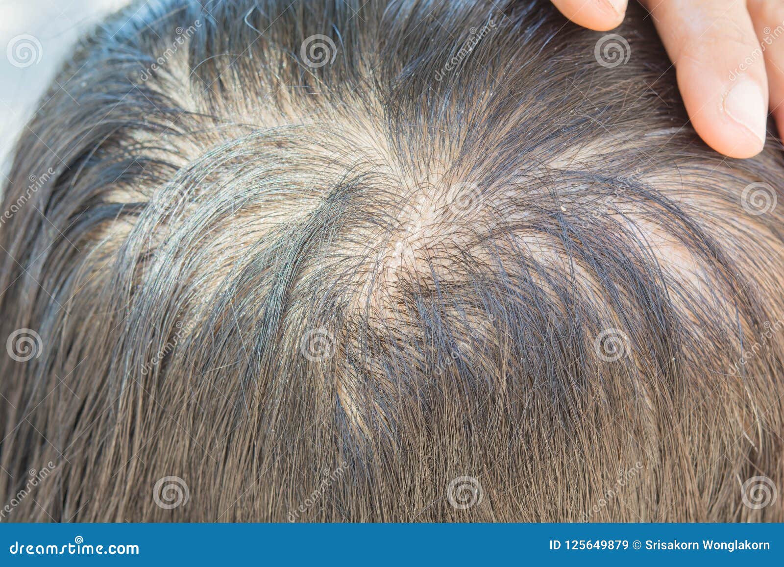 Thin hair and dandruff stock image. Image of care, back - 125649879