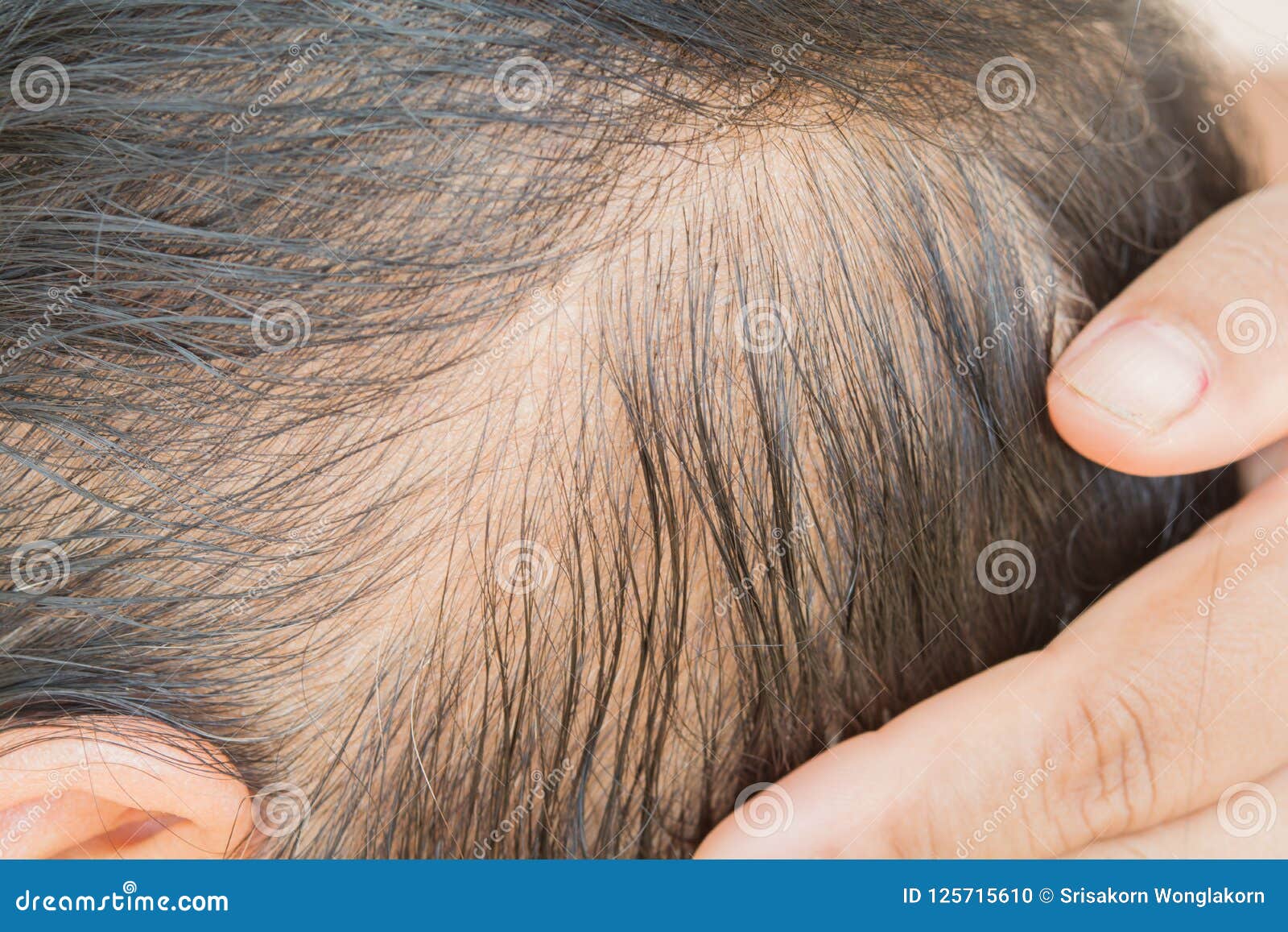 Thin Hair and Scalp and Broken Hair Stock Photo - Image of health, medical:  125715610