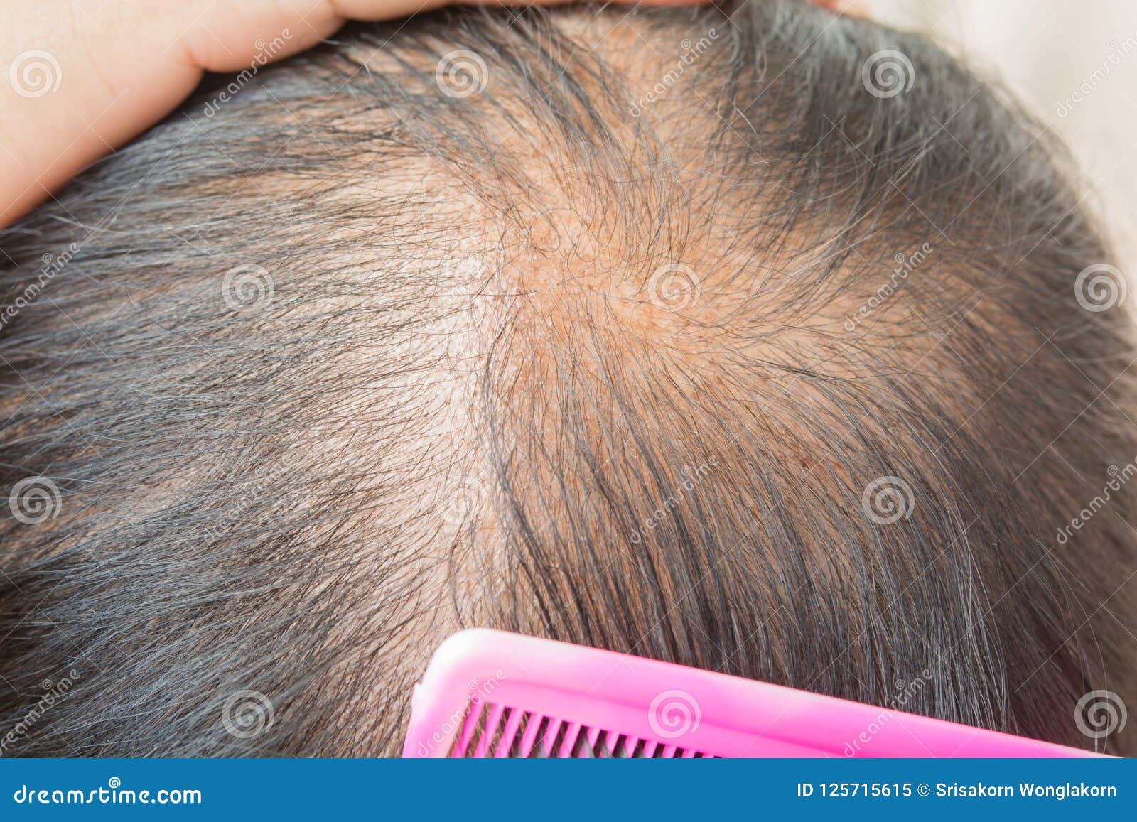 Thin Hair and Scalp and Broken Hair Stock Image - Image of oily, close:  125715615