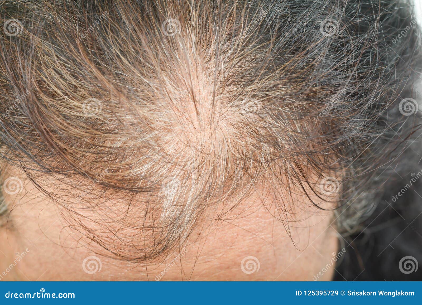 Thin hair in women stock image. Image of loss, care - 125395729