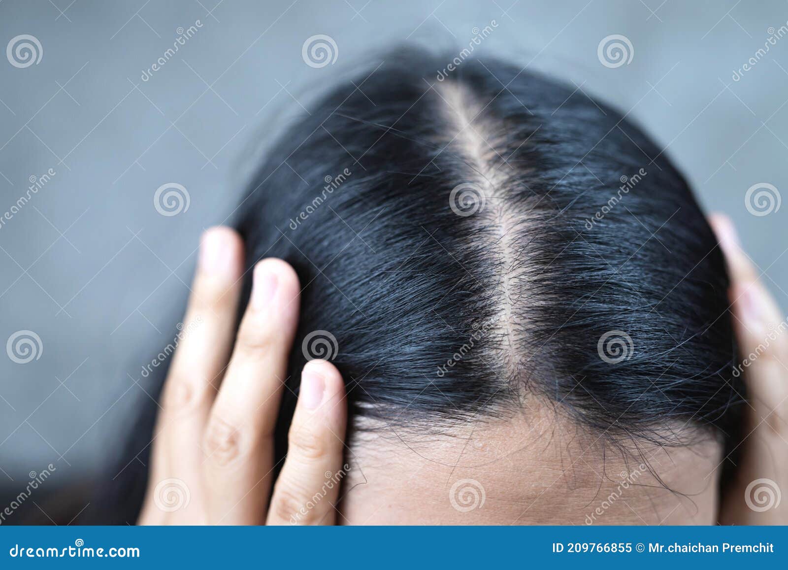 Scalp Problems  Causes Symptoms Types  How To Take Care