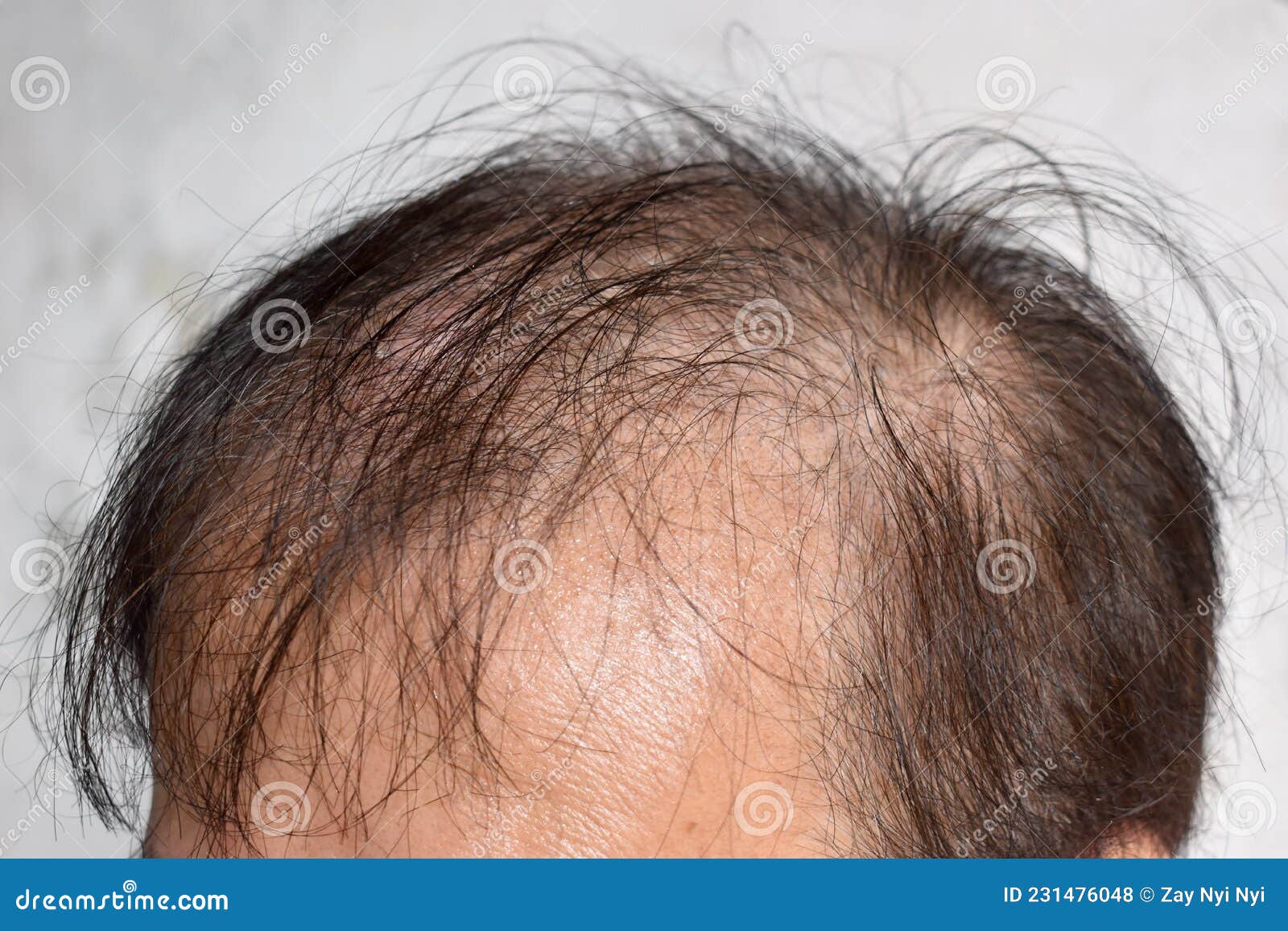 Thinning or Sparse Hair, Male Pattern Hair Loss in Asian Elder Man Stock  Photo - Image of head, older: 231476048