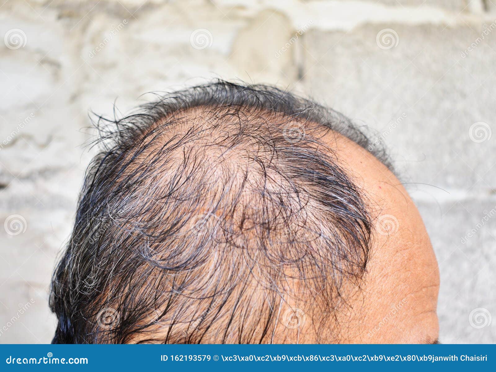 Thinning Or Sparse Hair, Male Pattern Hair Loss In Southeast Asian Stock  Image - Image Of Orange, Hairline: 162193579