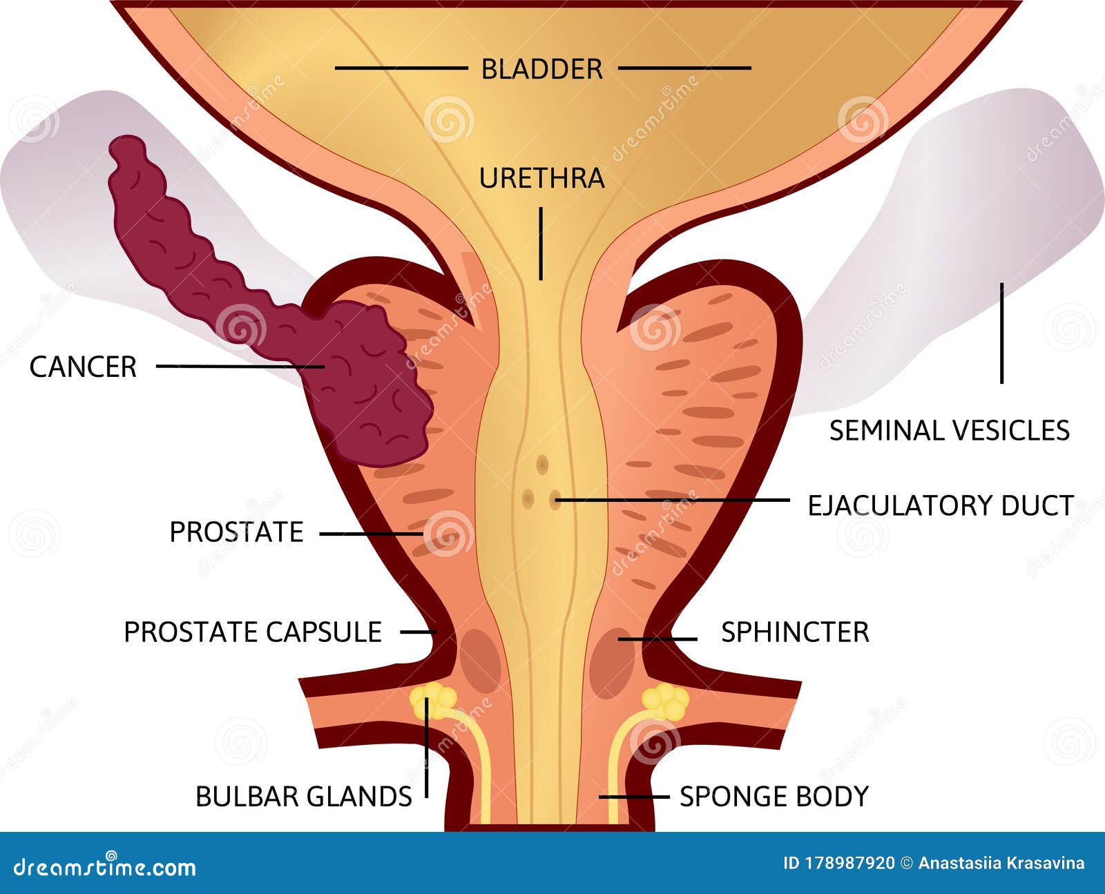 third stage of prostate cancer. the tumor is big and located in prostate and developed into seminal vesicles