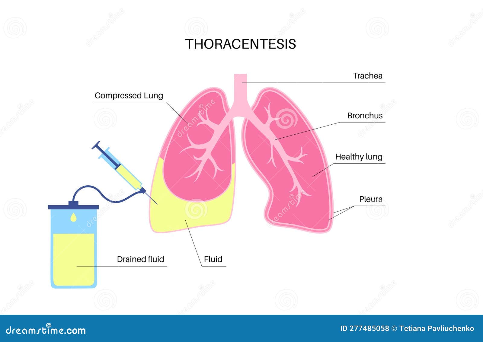 thoracentesis medical procedure