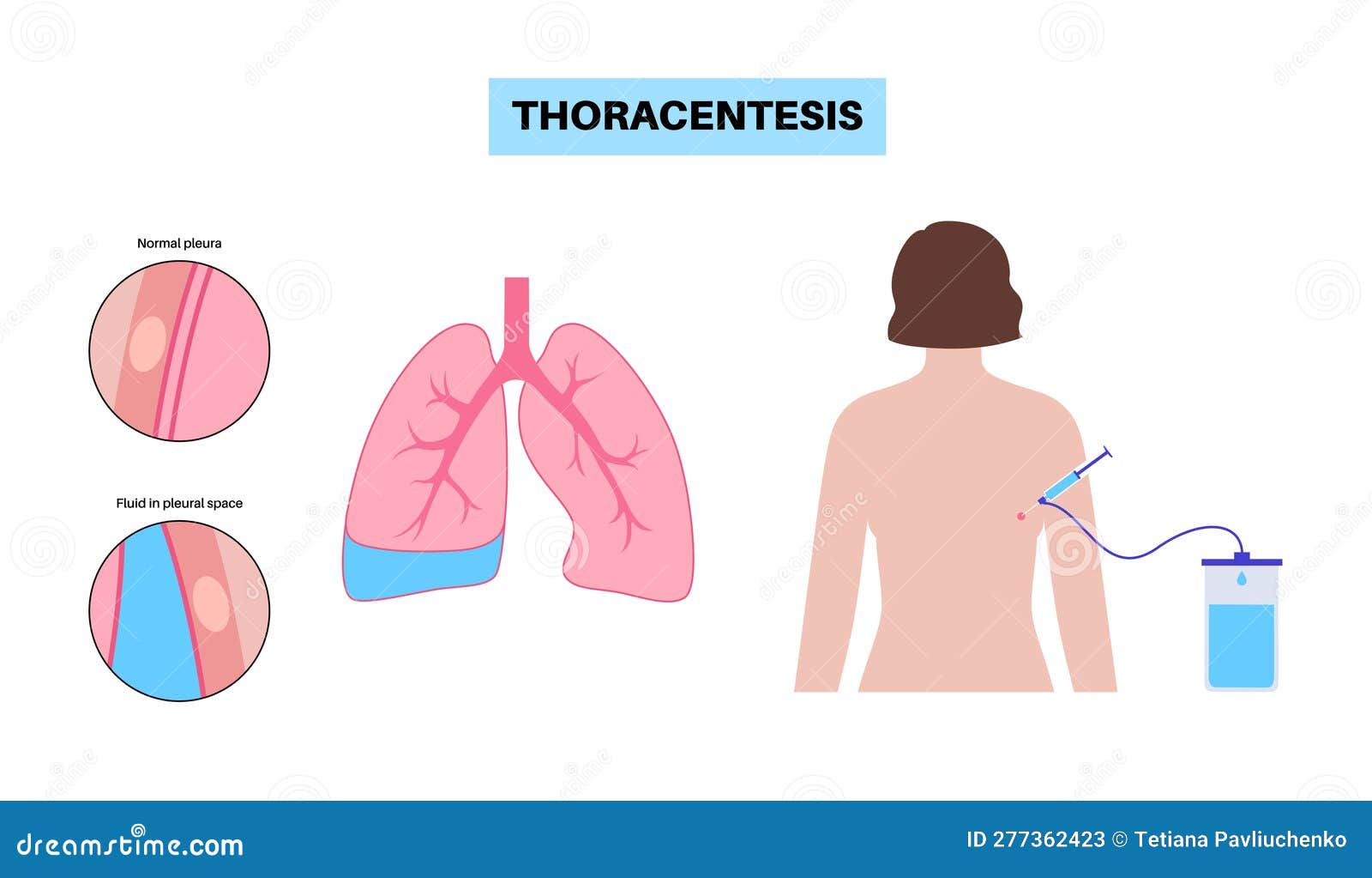 thoracentesis medical procedure