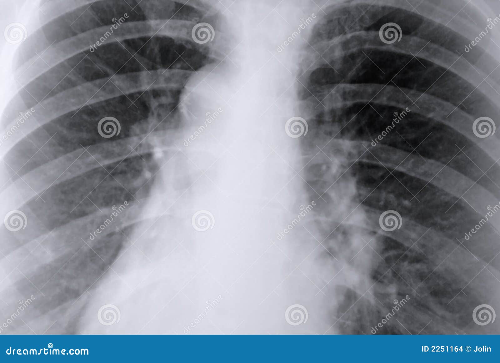 thorax x-ray of the lungs