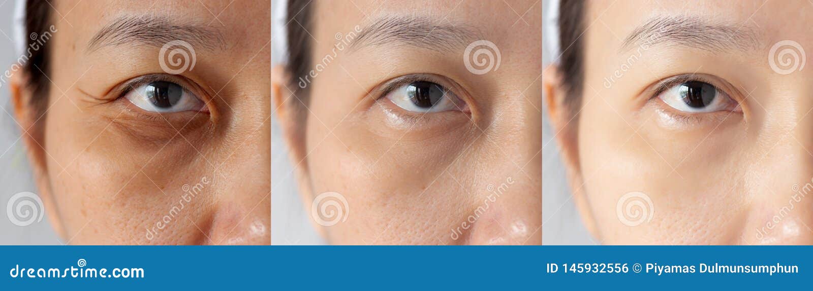 three pictures compared effect before and after treatment. under eyes with problems of dark circles ,puffiness and wrinkles