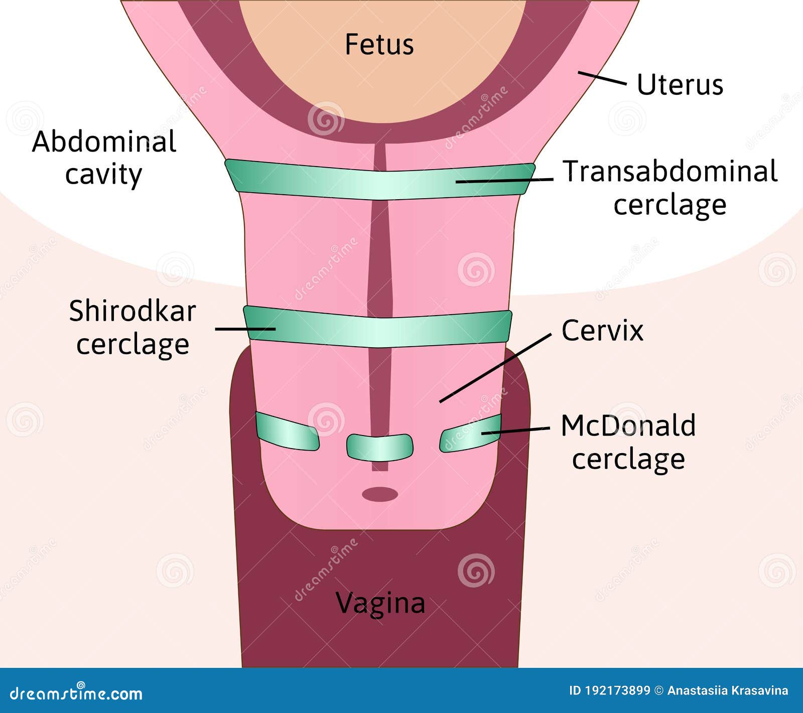 Uterus & Types Of Fibroids Vector Illustration | CartoonDealer.com