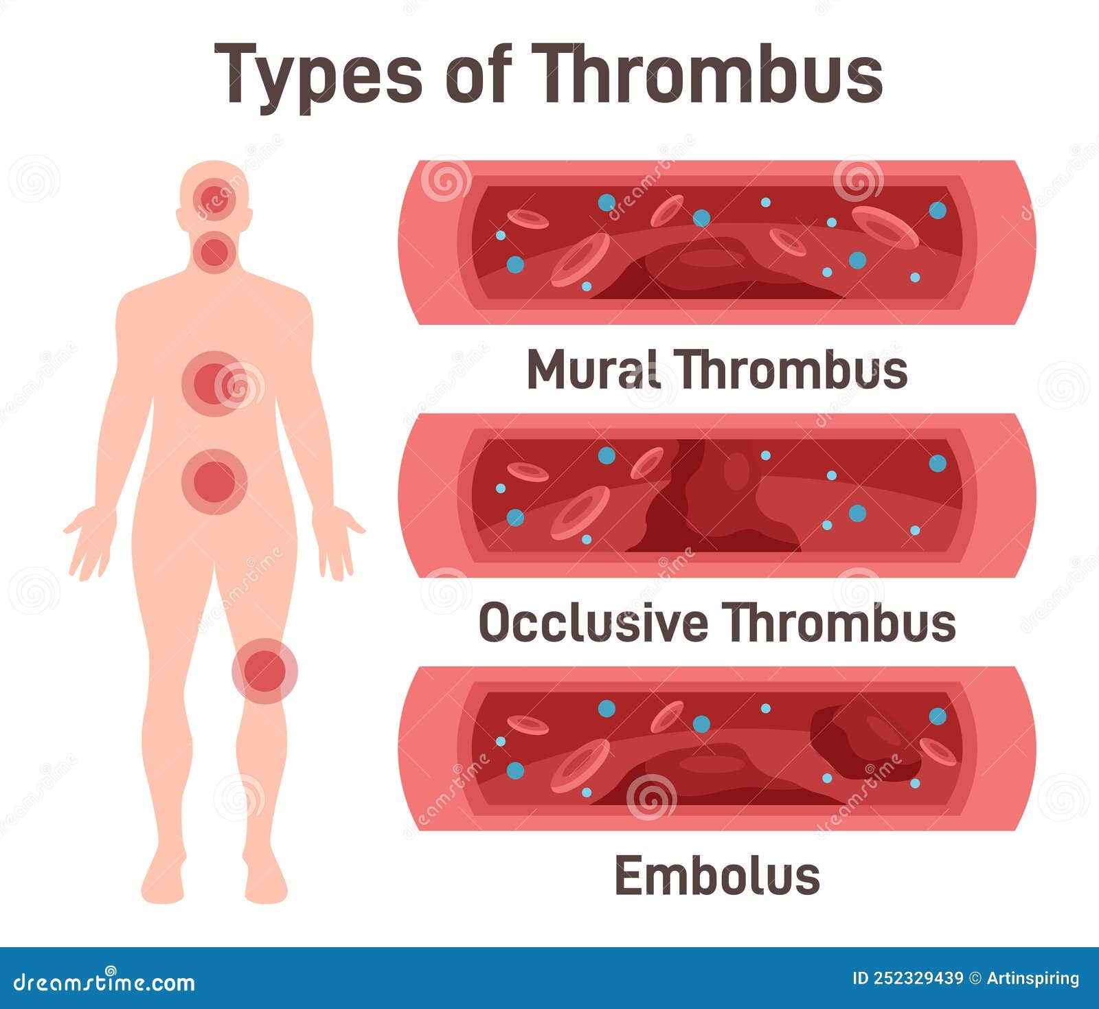 thrombus types. arteriosclerosis, infarct, ischemia, thrombosis disease.
