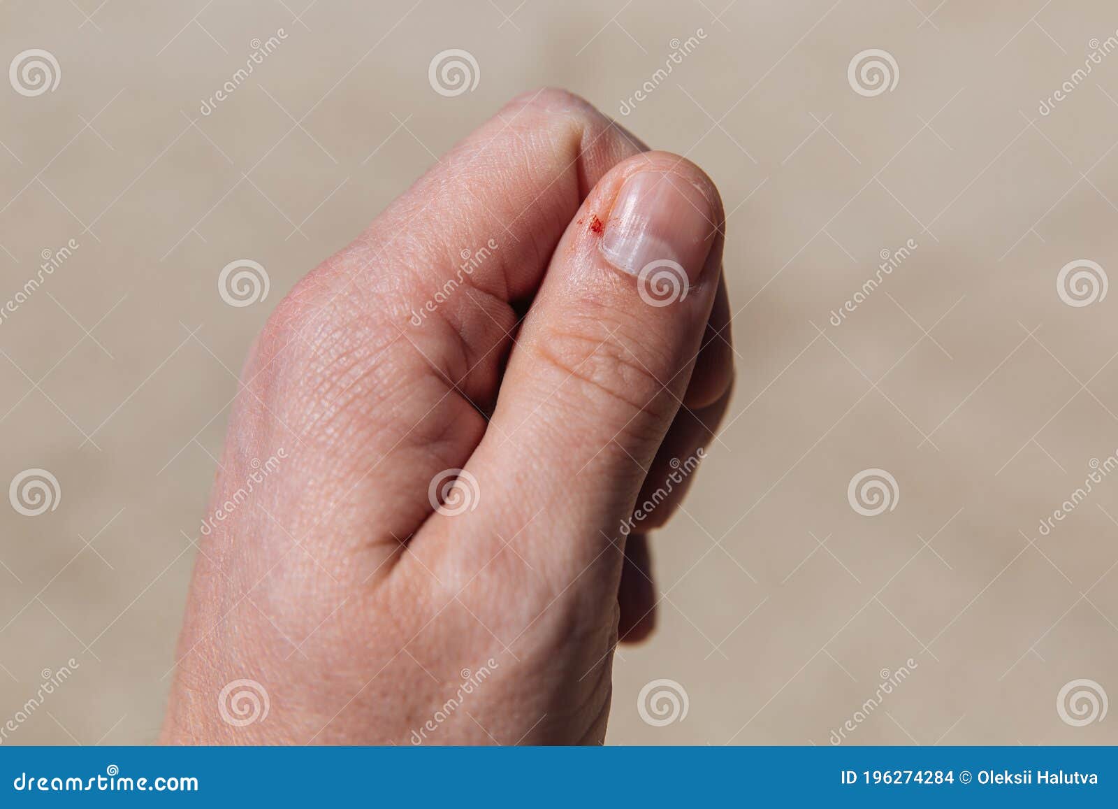 Are there any treatments for the skin beneath toe nails bleeding after  being cut? (Photo) - human
