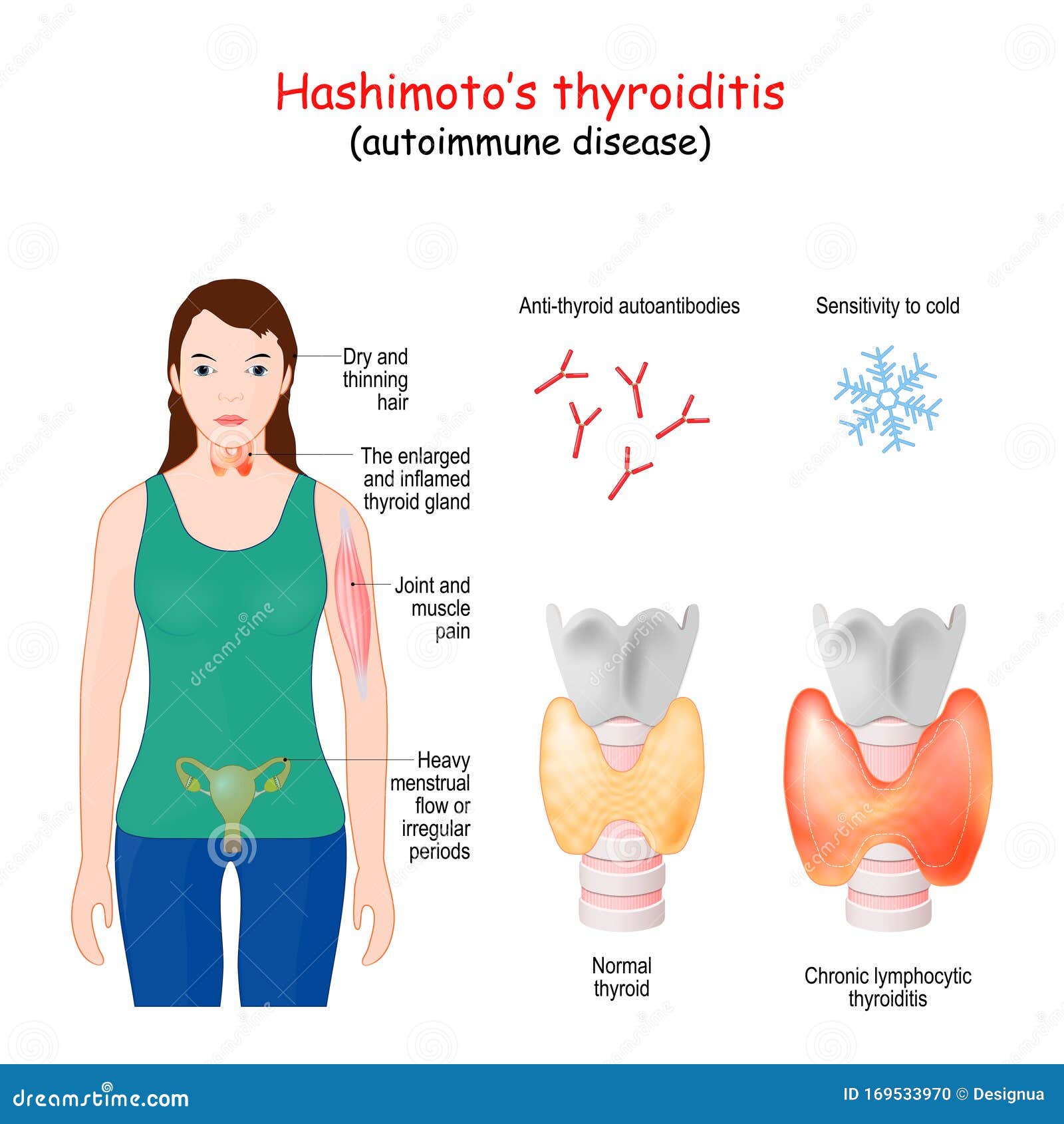 Was ist bei der Schilddrüse Hashimoto?