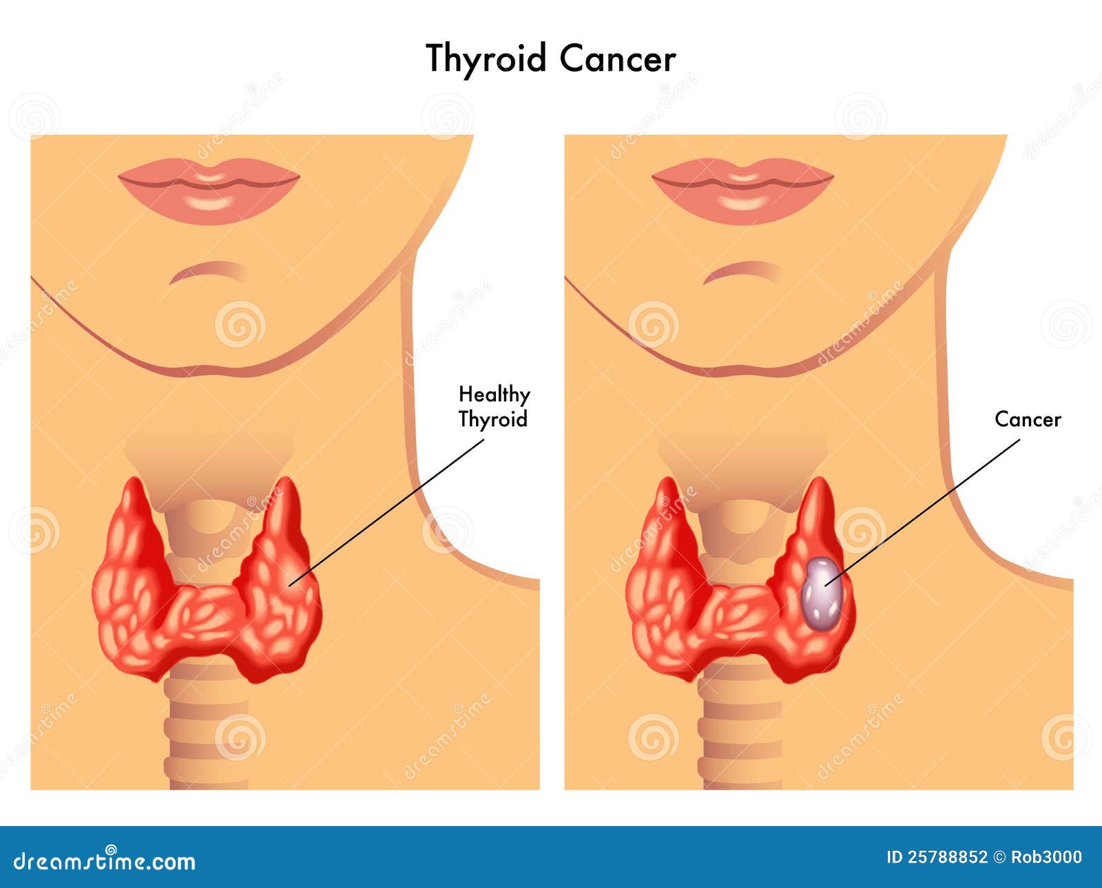 thyroid cancer