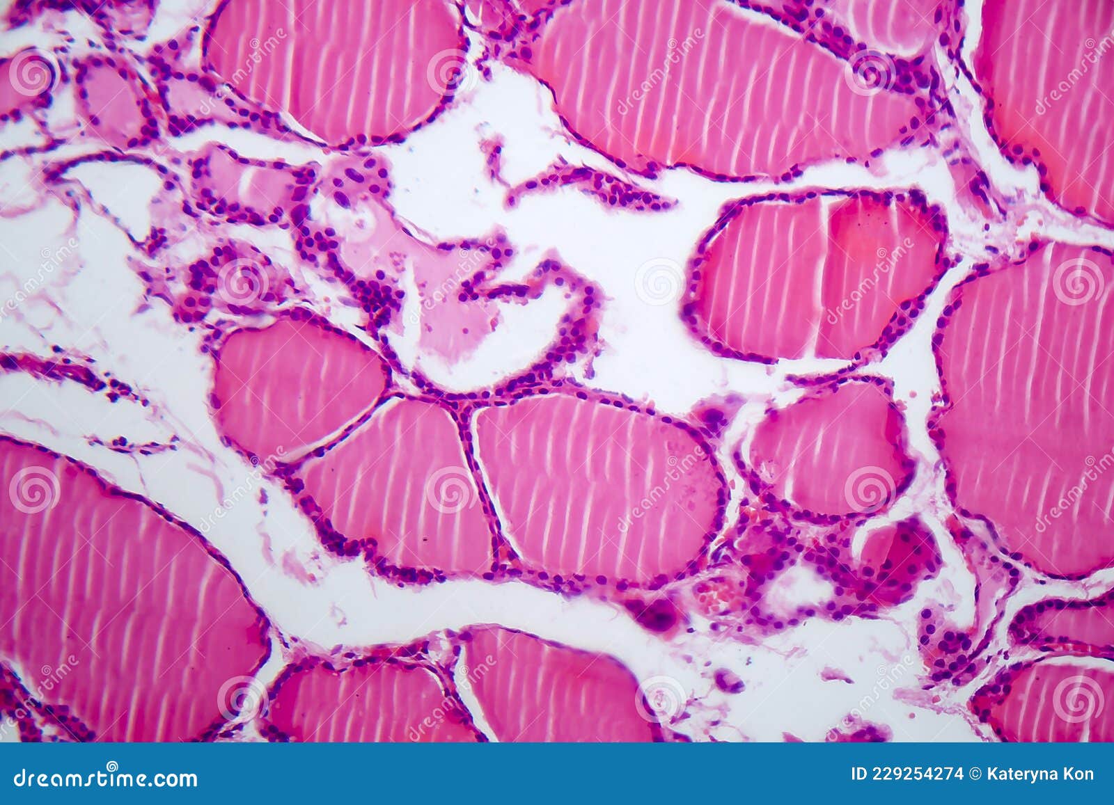 Thyroid Cancer, Light Micrograph Stock Photo Image of invasive, eosin