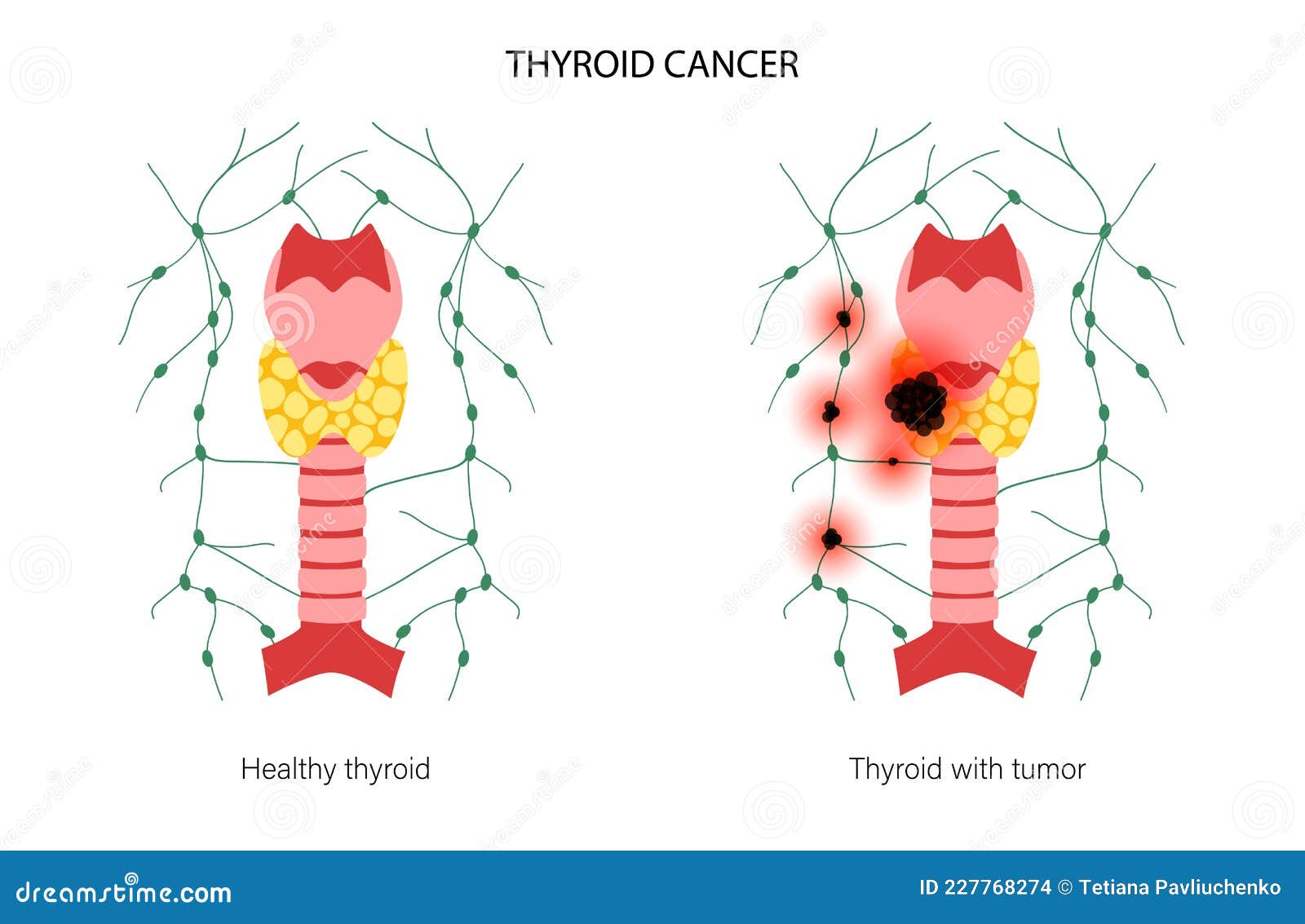 Thyroid Cancer Stages Stock Vector Illustration Of Hypothyroidism
