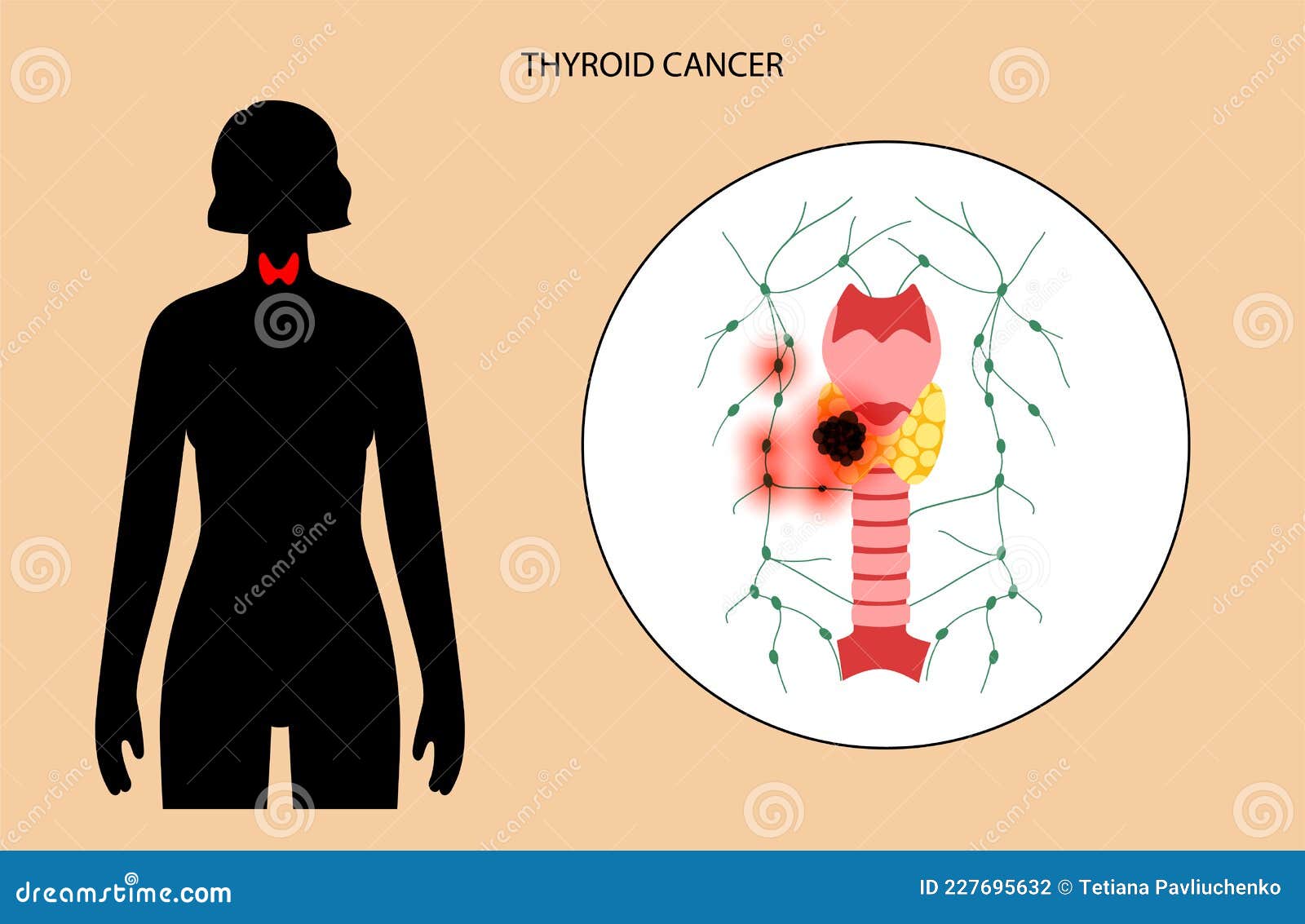 Thyroid Cancer Stages Stock Vector Illustration Of Tumor 227695632