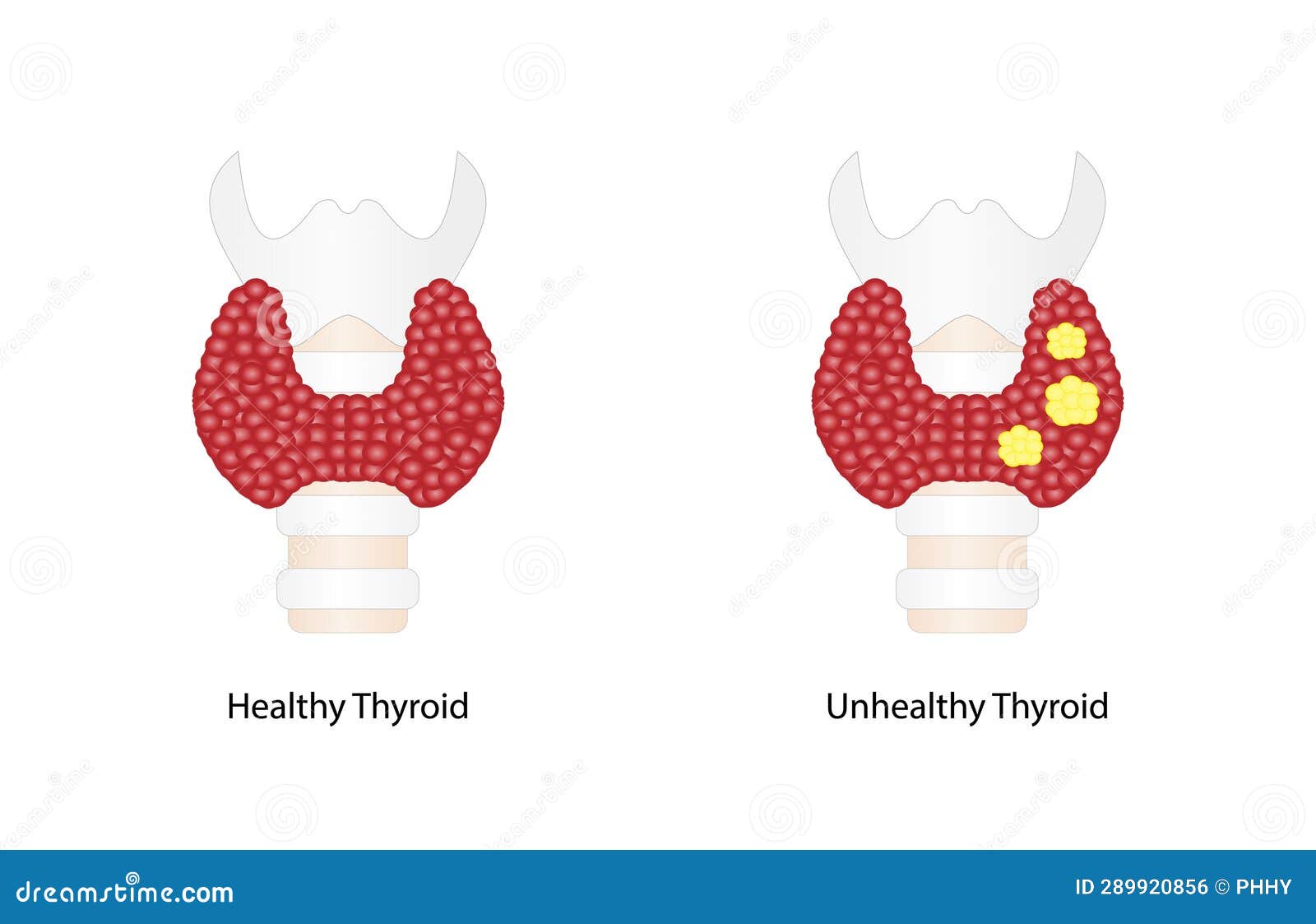 Thyroid Cancer, Unhealthy Thyroid with Inflammation and Lump. Stock