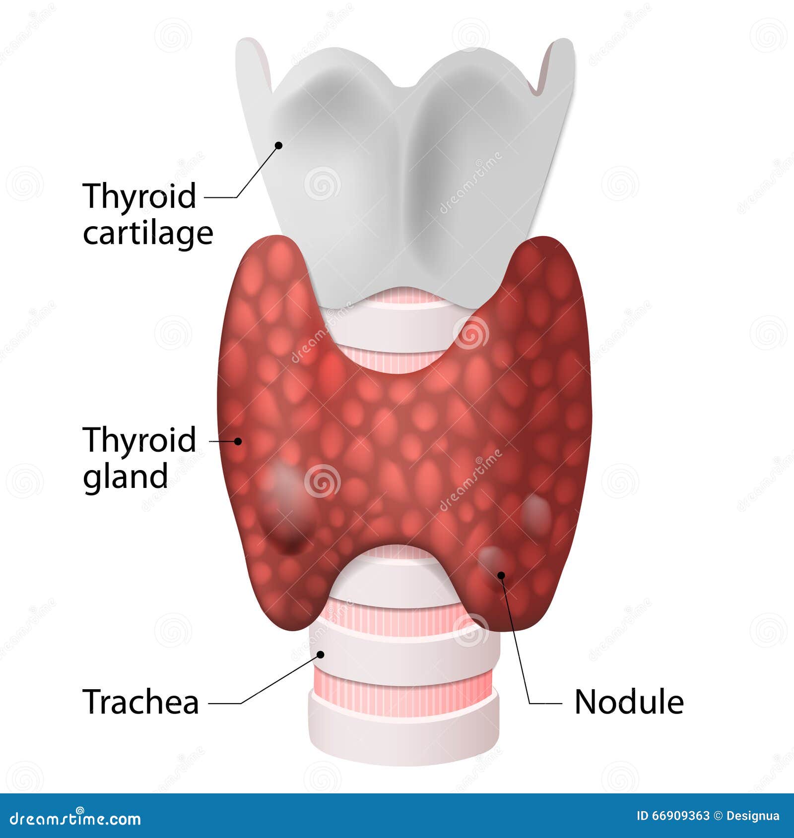 Goiter & Thyroid Nodules