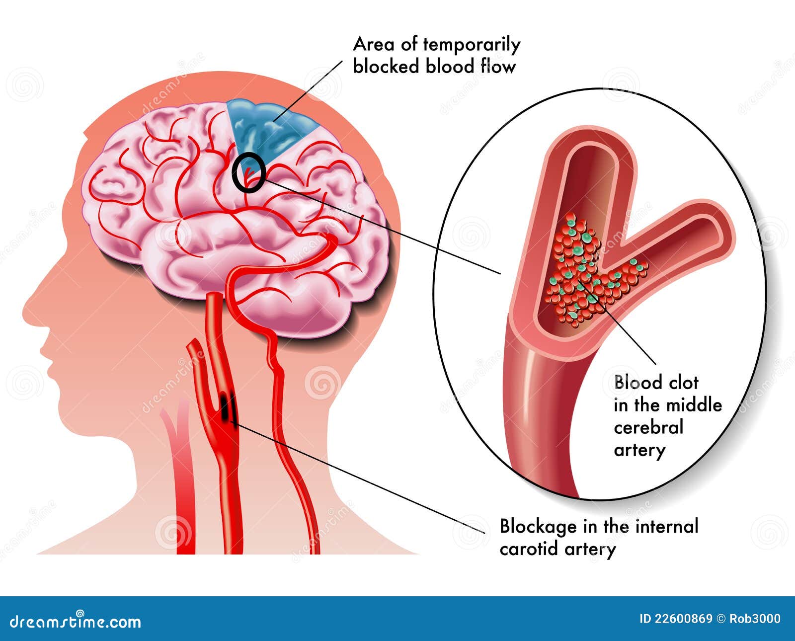 tia (transient ischemic attack)