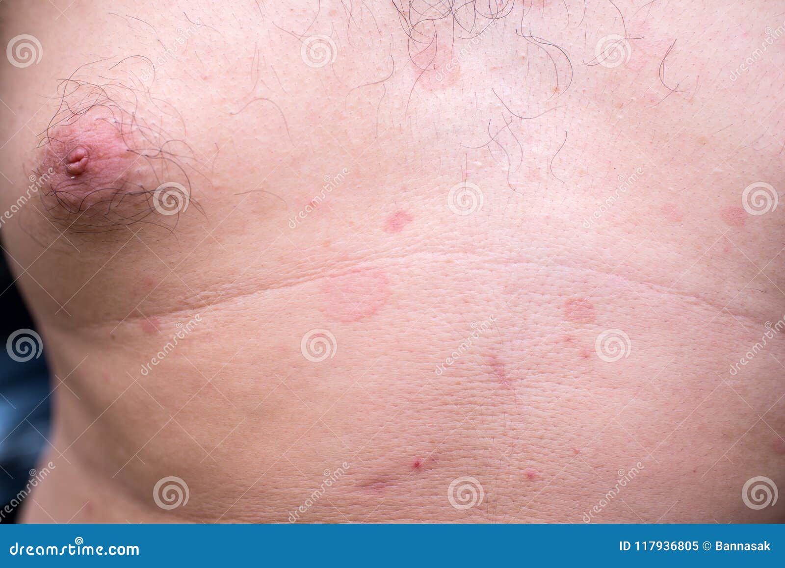 Tinha no corpo imagem de stock. Imagem de fungos, partido - 117936805, image size:1600x1158