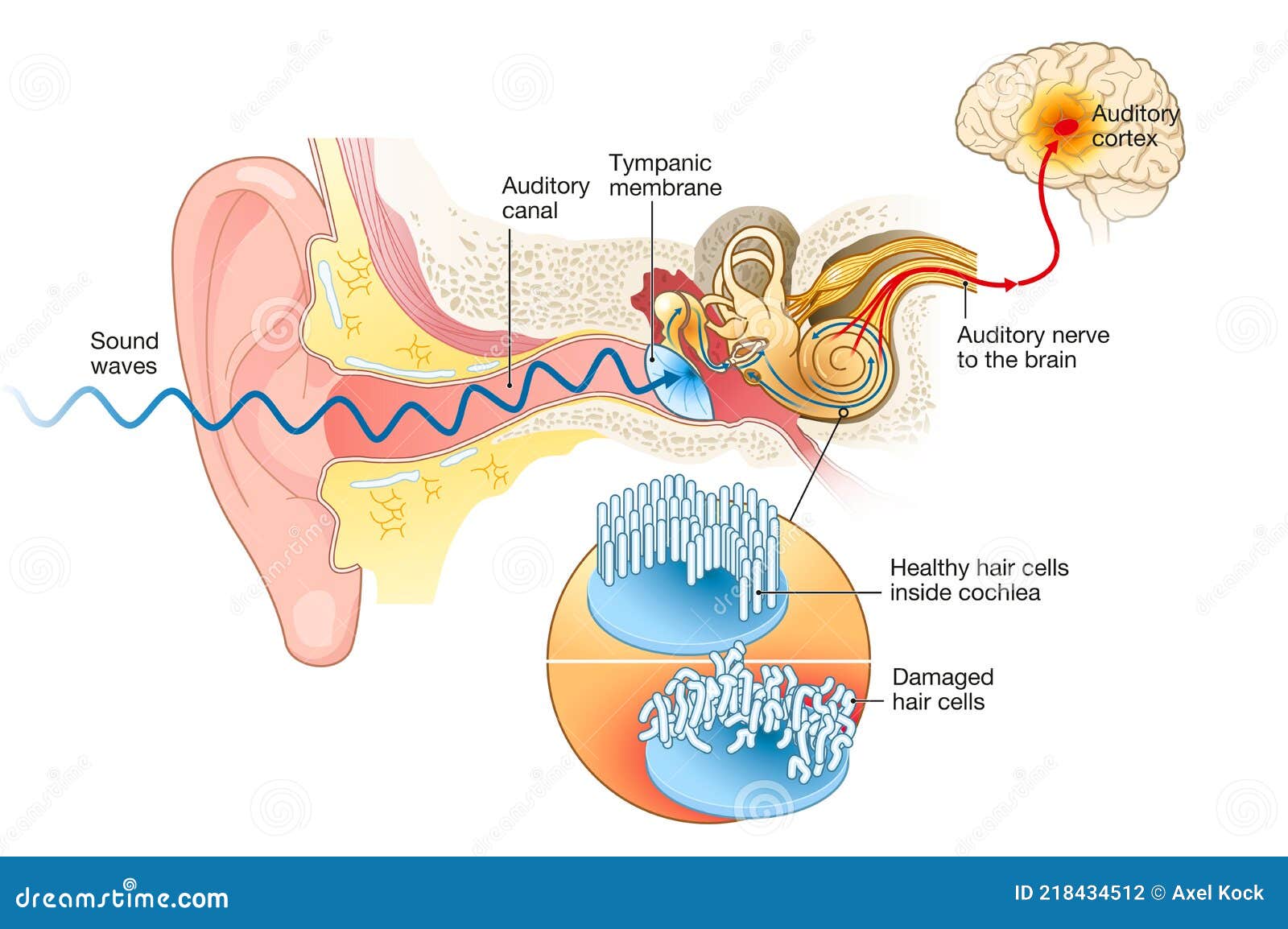 tinnitus. damaged hair cells inside cochlea