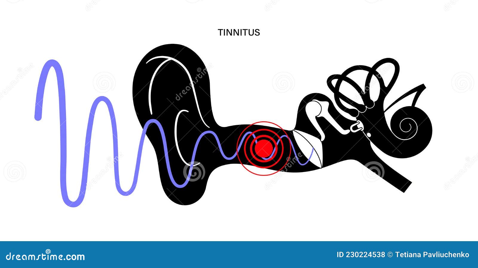 Tinnitus: Causes, Symptoms, Risk Factors, Diagnosis, Treatment, Prevention  and Complications