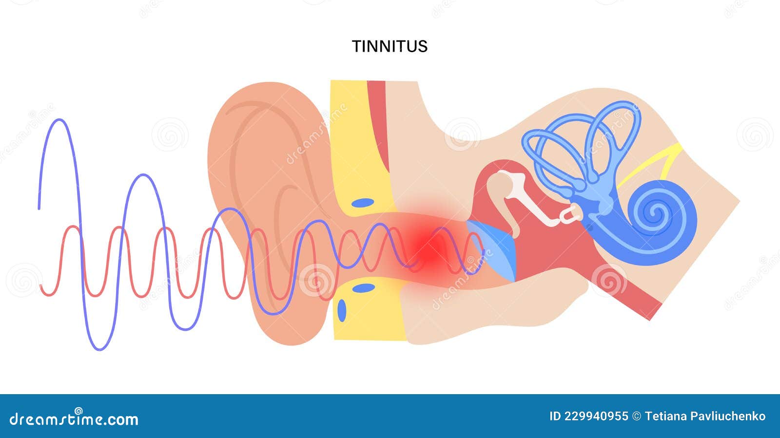 tinnitus disease concept