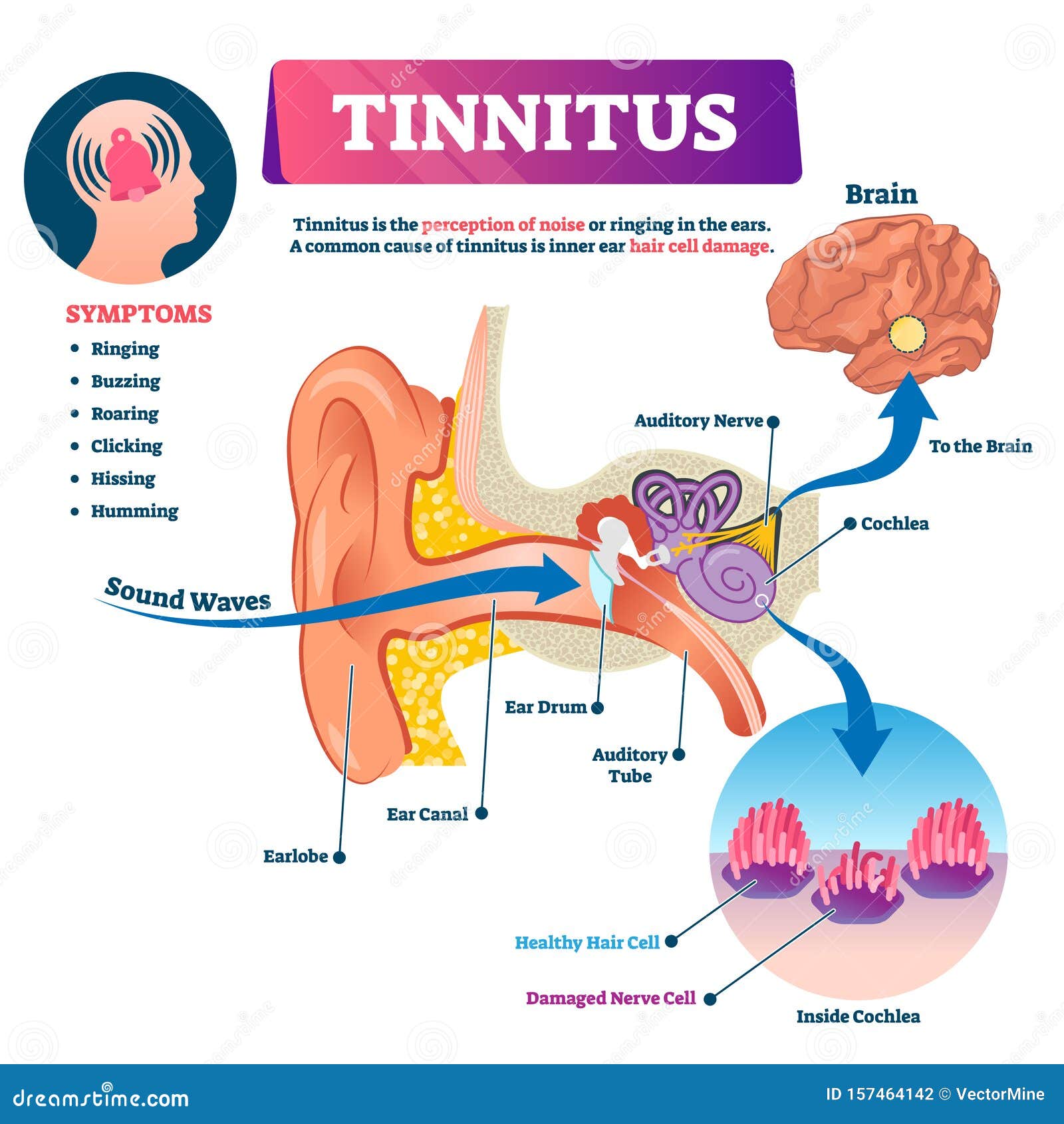 tinnitus  . labeled shingles noise perception ear problem