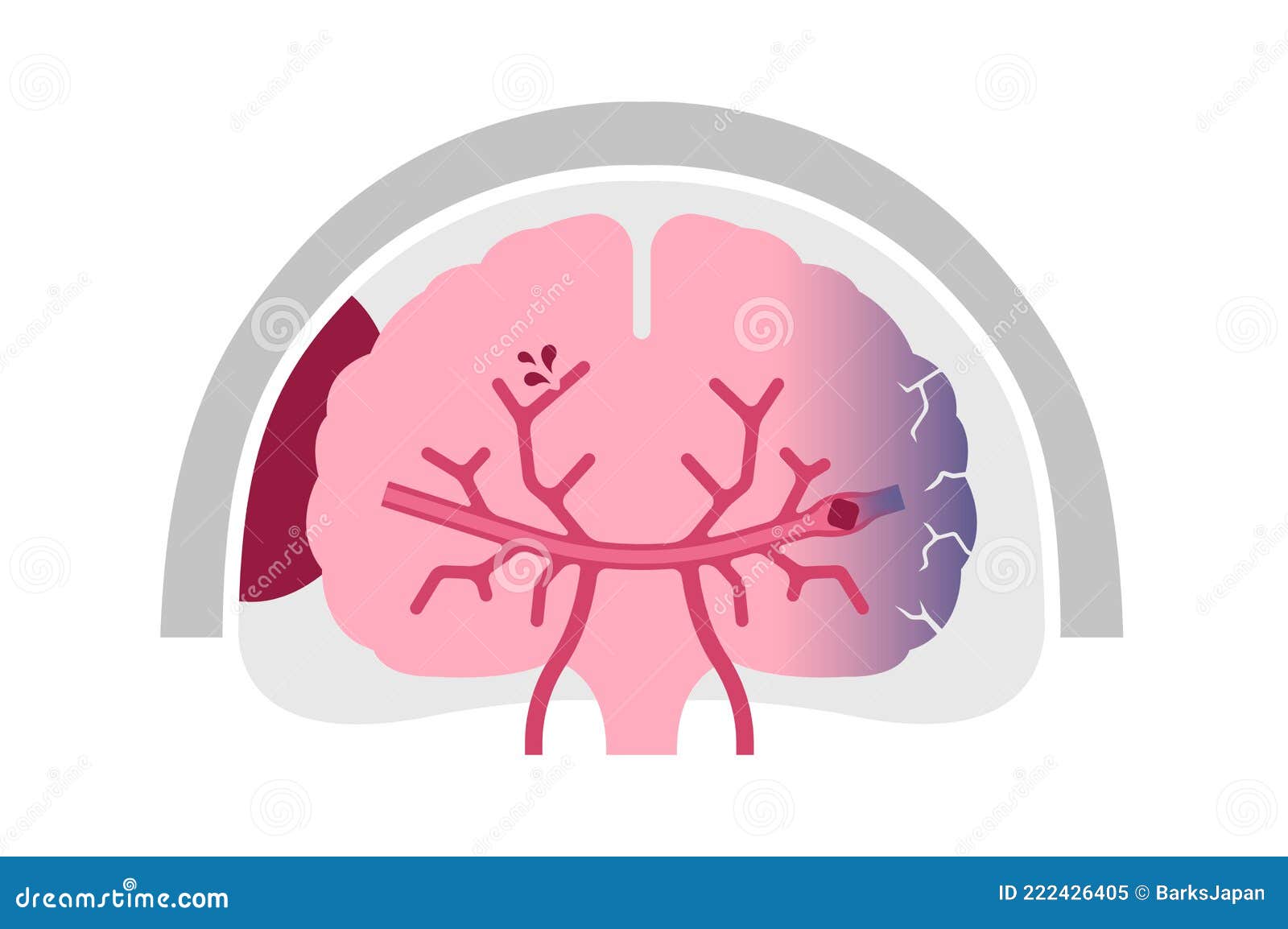 Tipos De Ilustraciones Del Vector Del Infarto Cerebral Humano | The ...