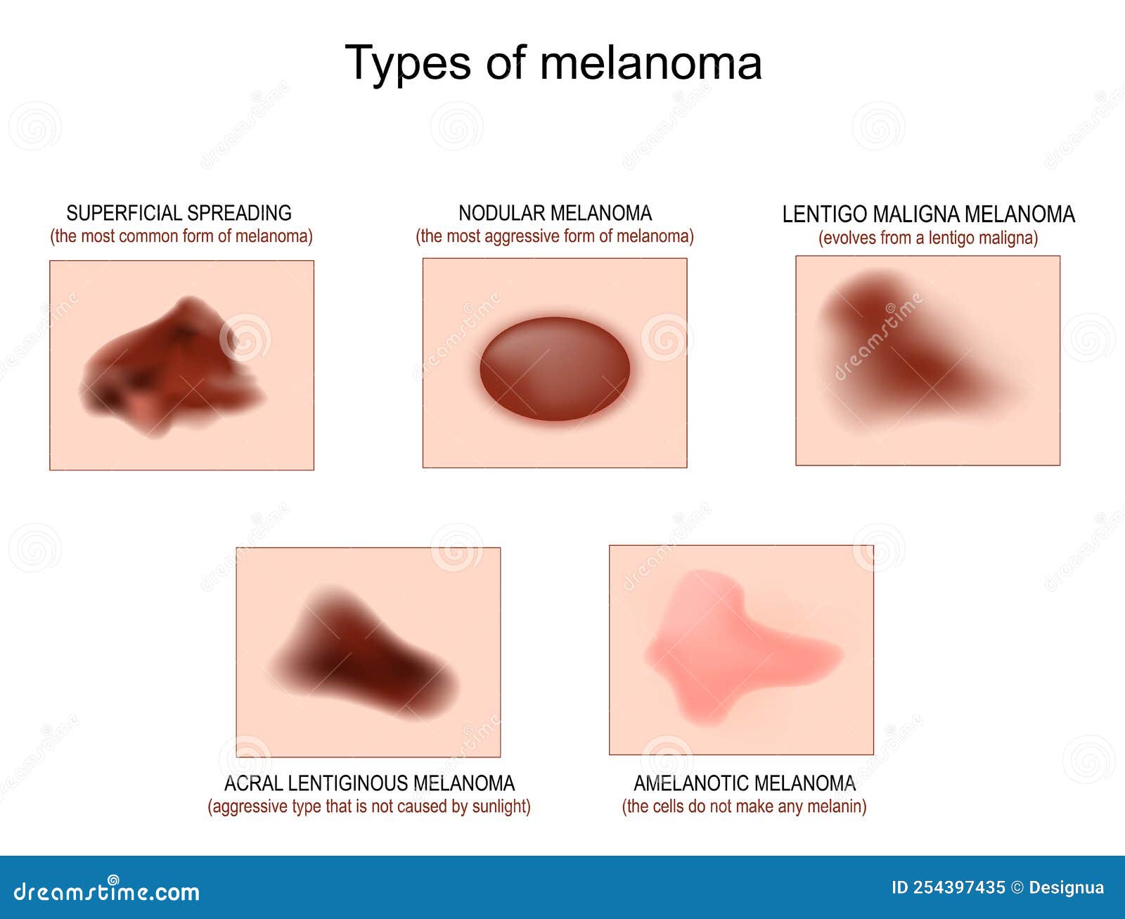 Tipos de melanoma ilustração do vetor. Ilustração de maligno 254397435