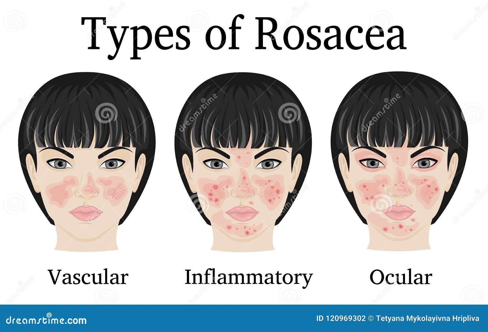 Tipos de Rosacea ilustración del vector. Ilustración de dolor 120969302