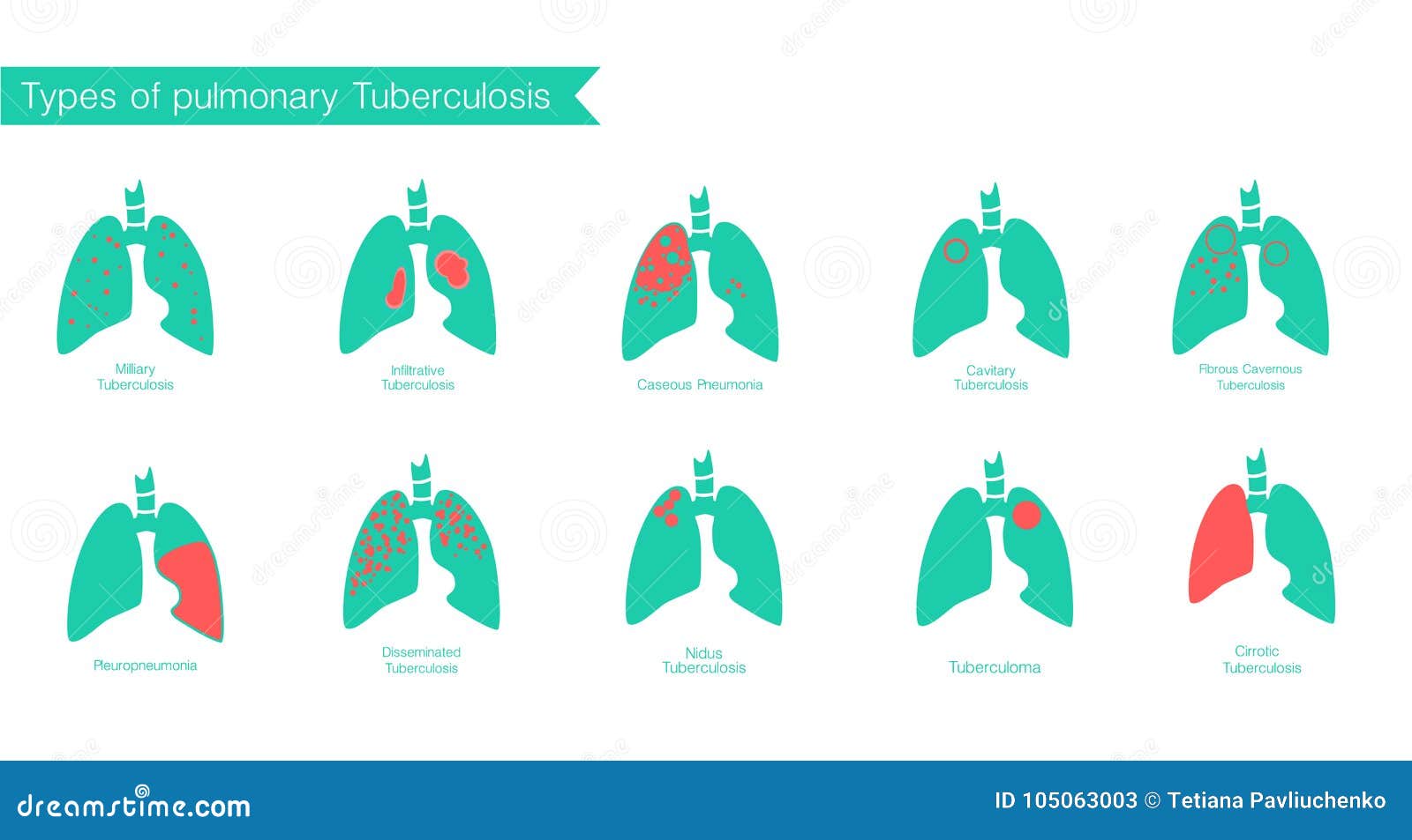 Полость заболевания легких. Туберкулез Векторная Графика. Туберкулез Векторная картинка. Туберкулез инфографика.