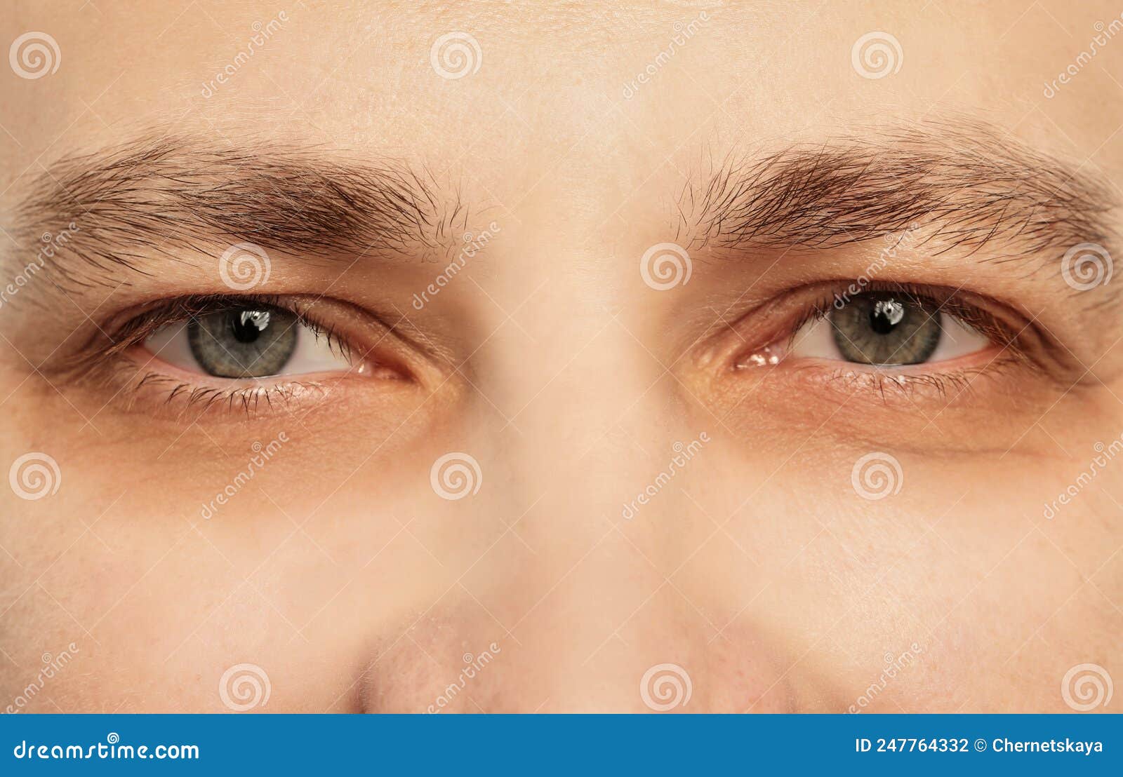 Tired Man with Dark Circles Under Eyes, Closeup Stock Photo Image of