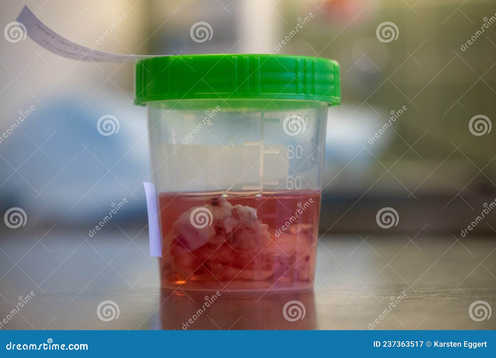 Tissue Sample is Placed in a Formalinfilled Cup after an Operation