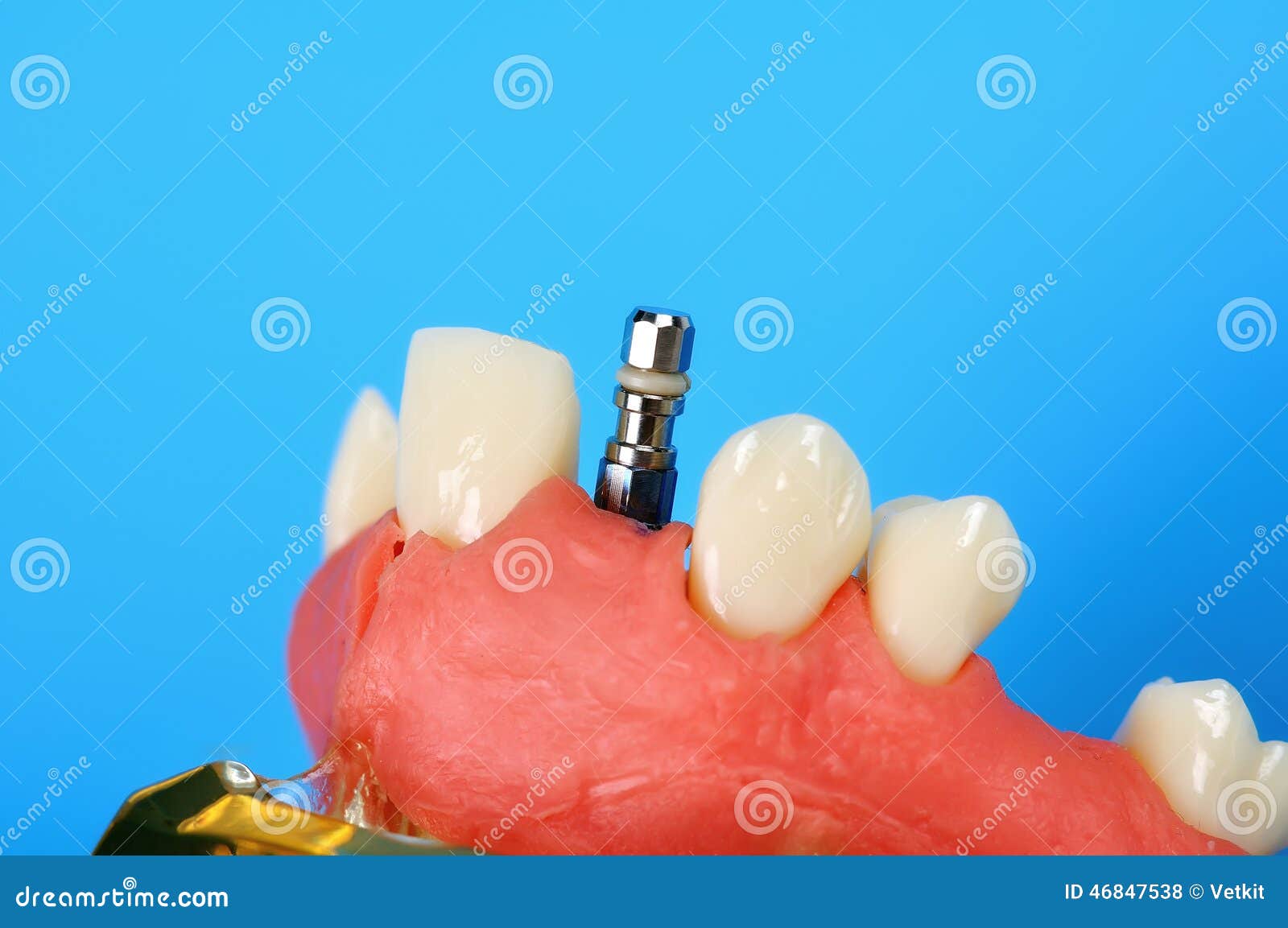 Titanium implant stock photo. Image of denture, mouth 46847538