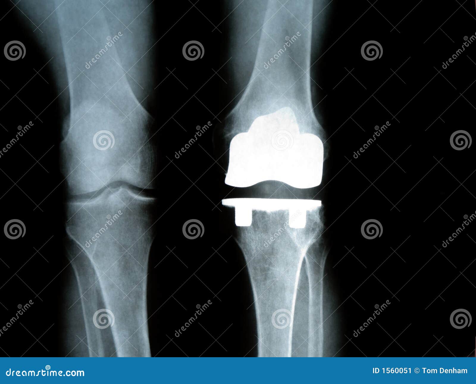 titanium knee