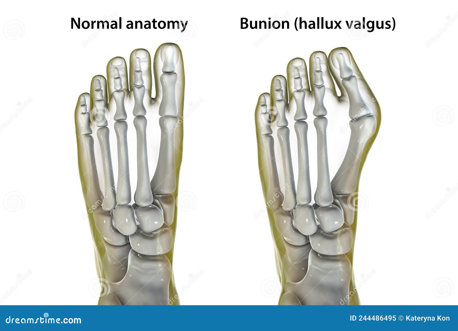 Normal And Bunion Hallux Valgus Foot, Illustration Drawing On White ...