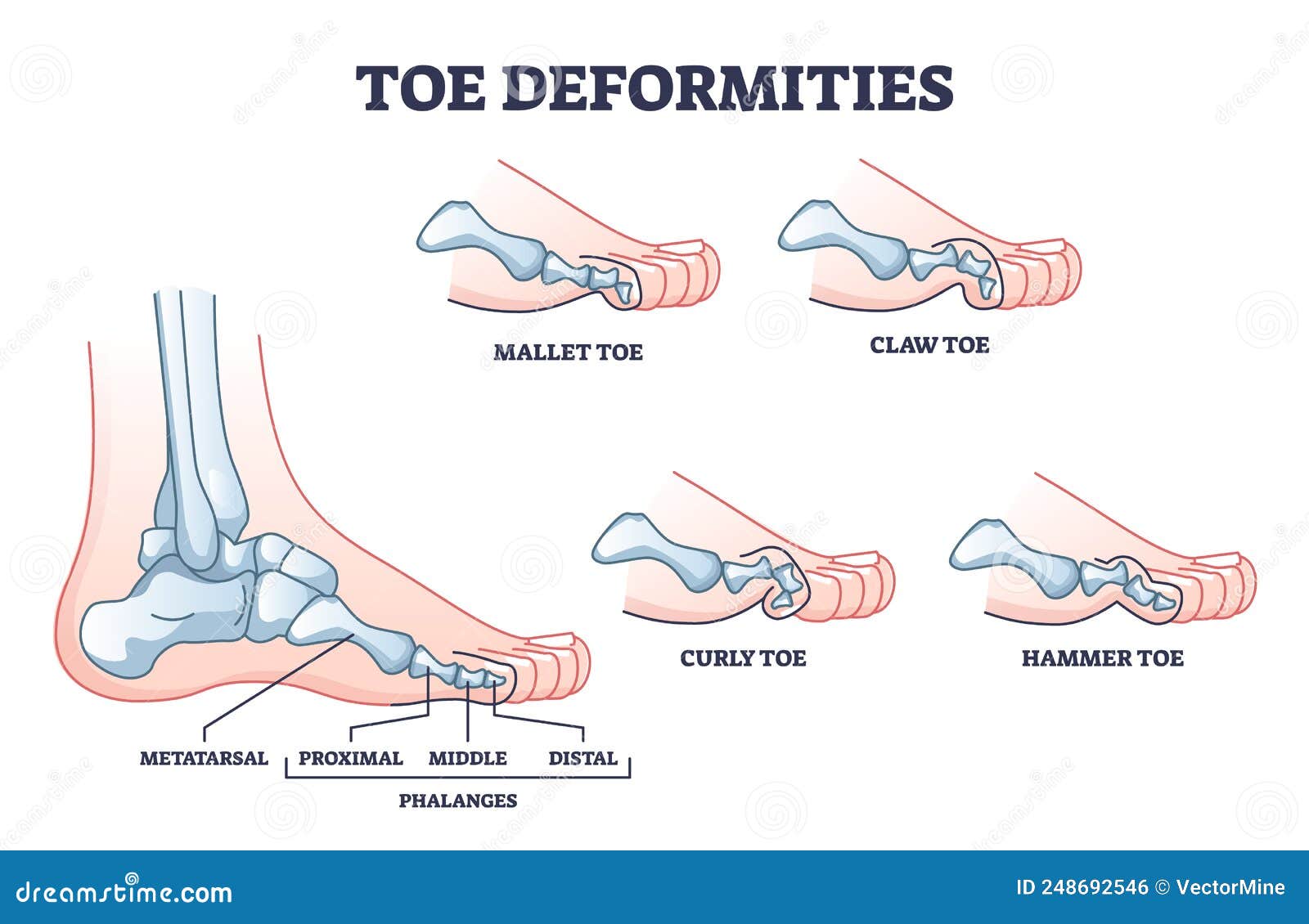 toe deformities and medical foot phalanges bone defects outline diagram