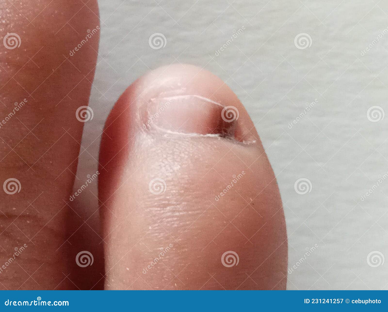 Toe Nail that Has a Dark Spot, Subungual Hematoma Stock Image - Image of  medical, clean: 231241257