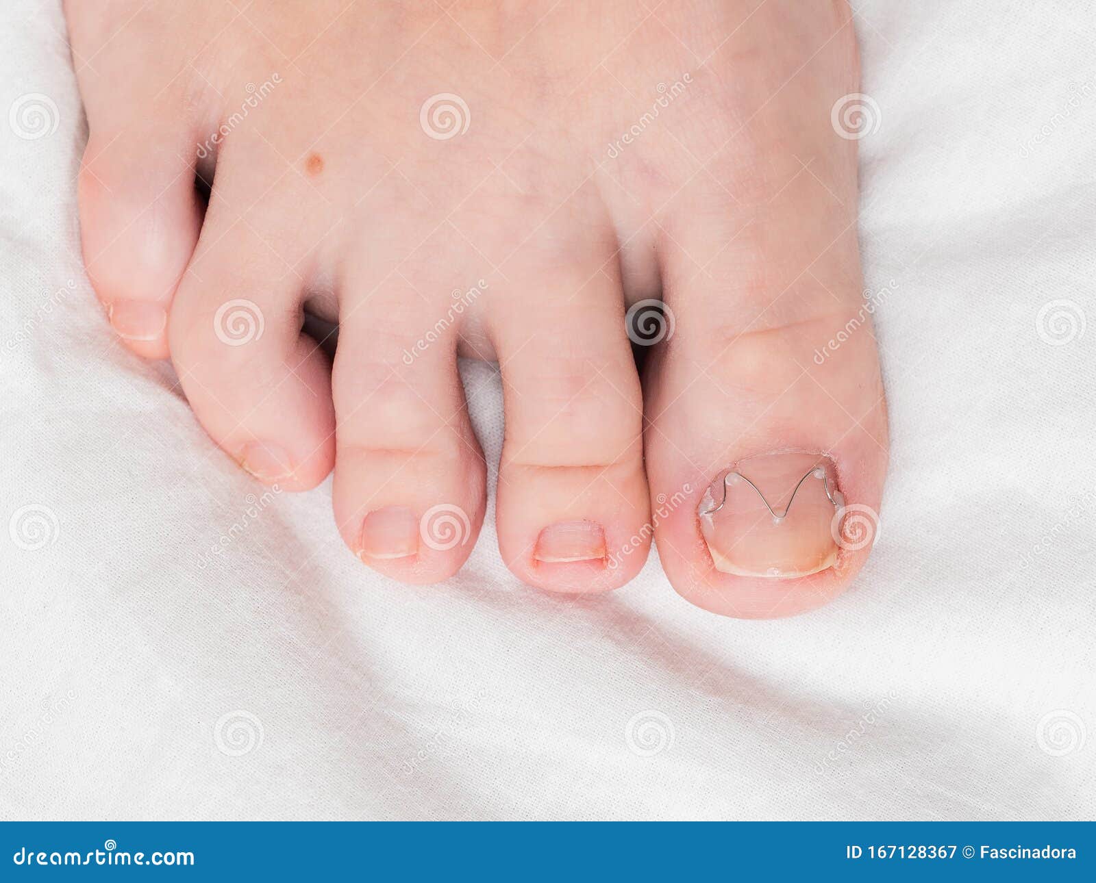 How Long Does It Take for a Toenail to Grow Back?