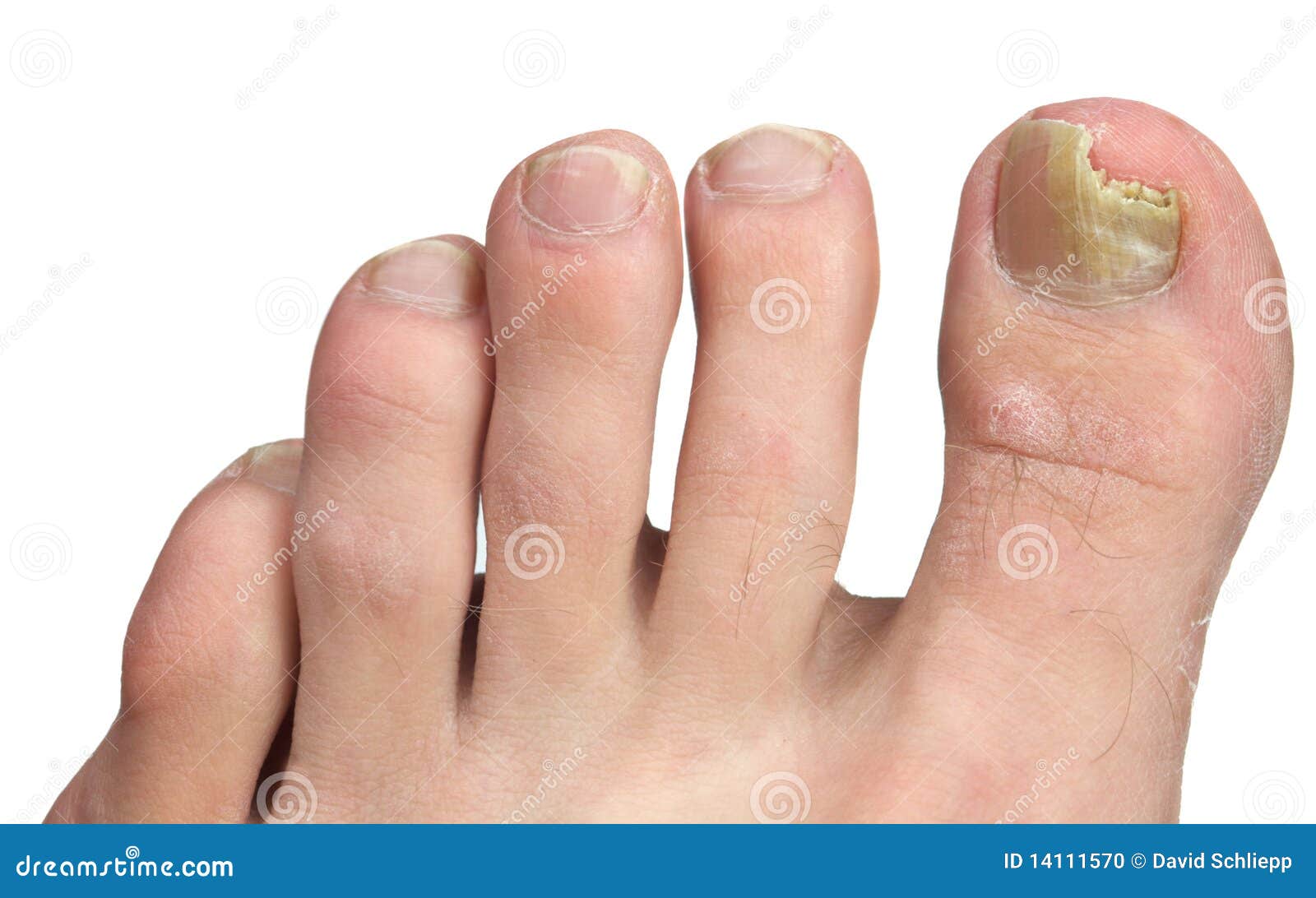 gombák nail thumb foot