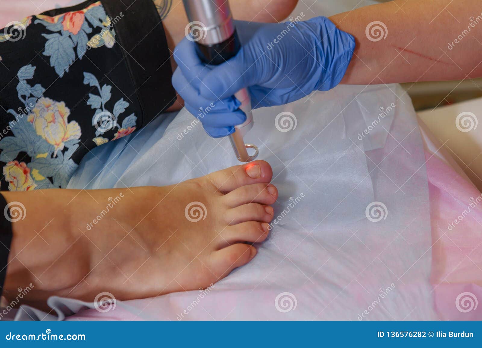 Toenail Fungus Treatment With Foot Laser At Laser Nail Therapy Stock Photo Image of female