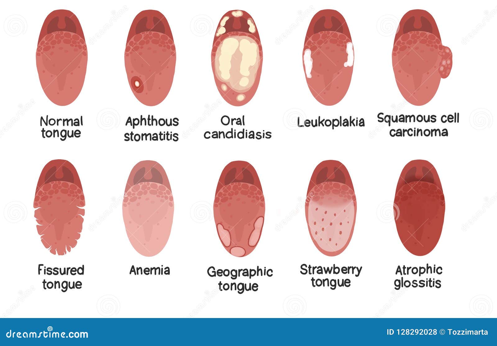 Disease Of The Tongue Cartoon Vector | CartoonDealer.com #78947545
