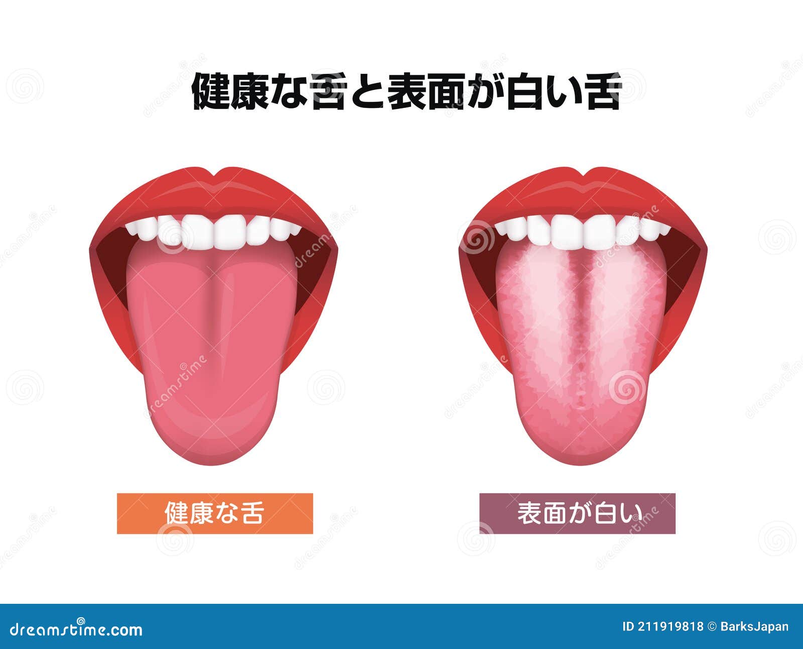 Tongueâ€™s Health Sign Vector Illustration White Coated Tongue Stock ...