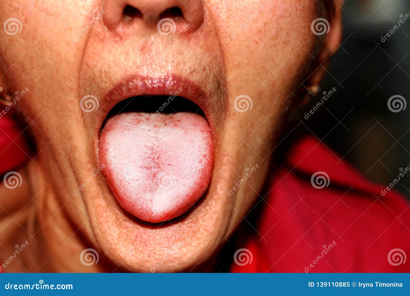 The Tongue is in a White Raid. Candidiasis in the Tongue Stock Image