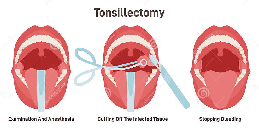 Tonsillectomy Acute Pharyngitis Treatment Surgical Removal Of The tonsillectomy-acute-pharyngitis-treatment-surgical-removal-of-the