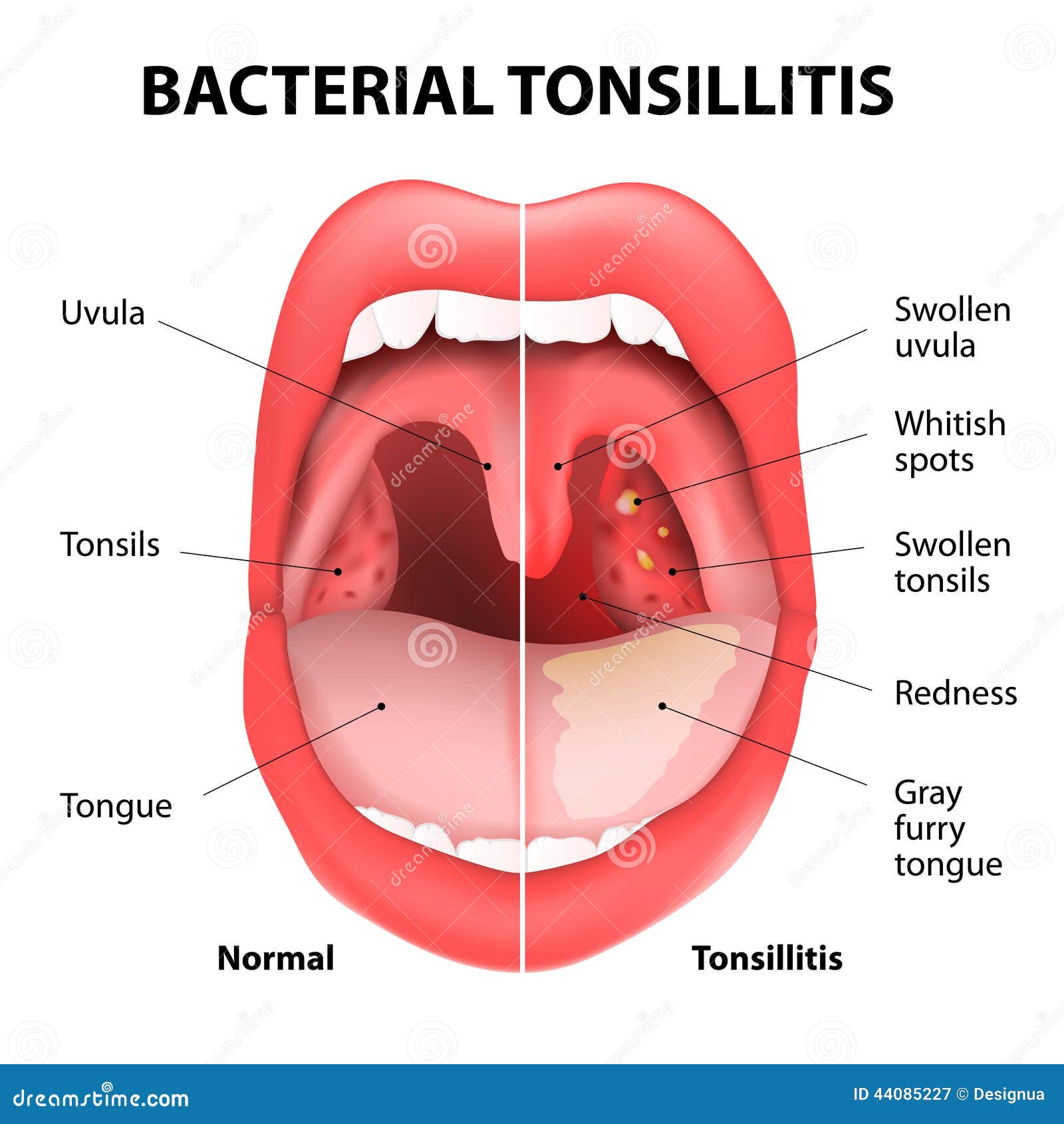 tonsillitis bacterial